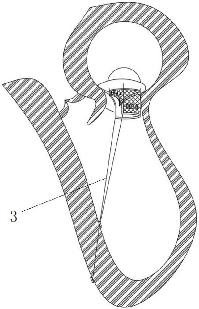 Mitral valve replacement system for percutaneous transcatheter