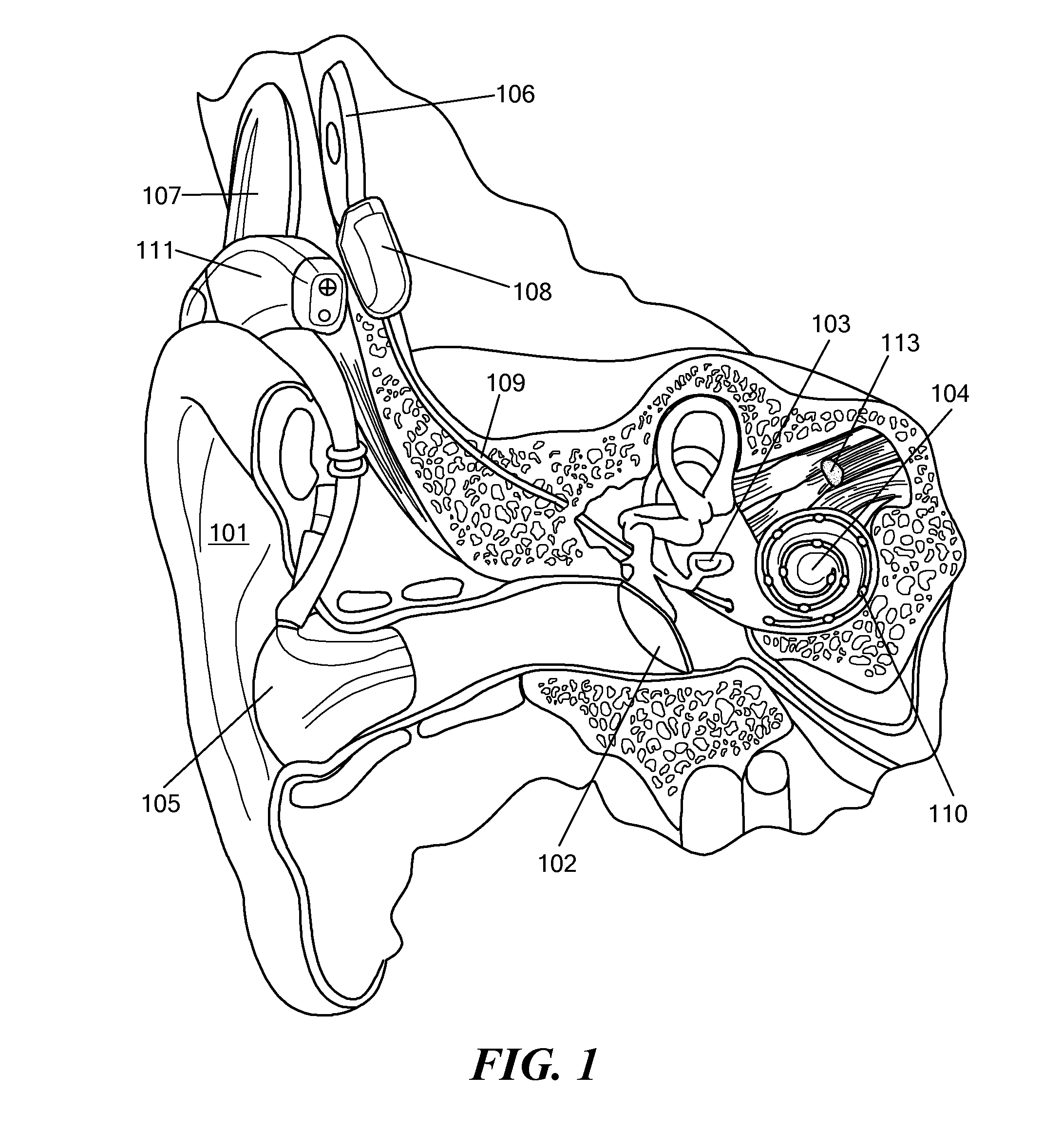 Fitting Unilateral Electric Acoustic Stimulation for Binaural Hearing