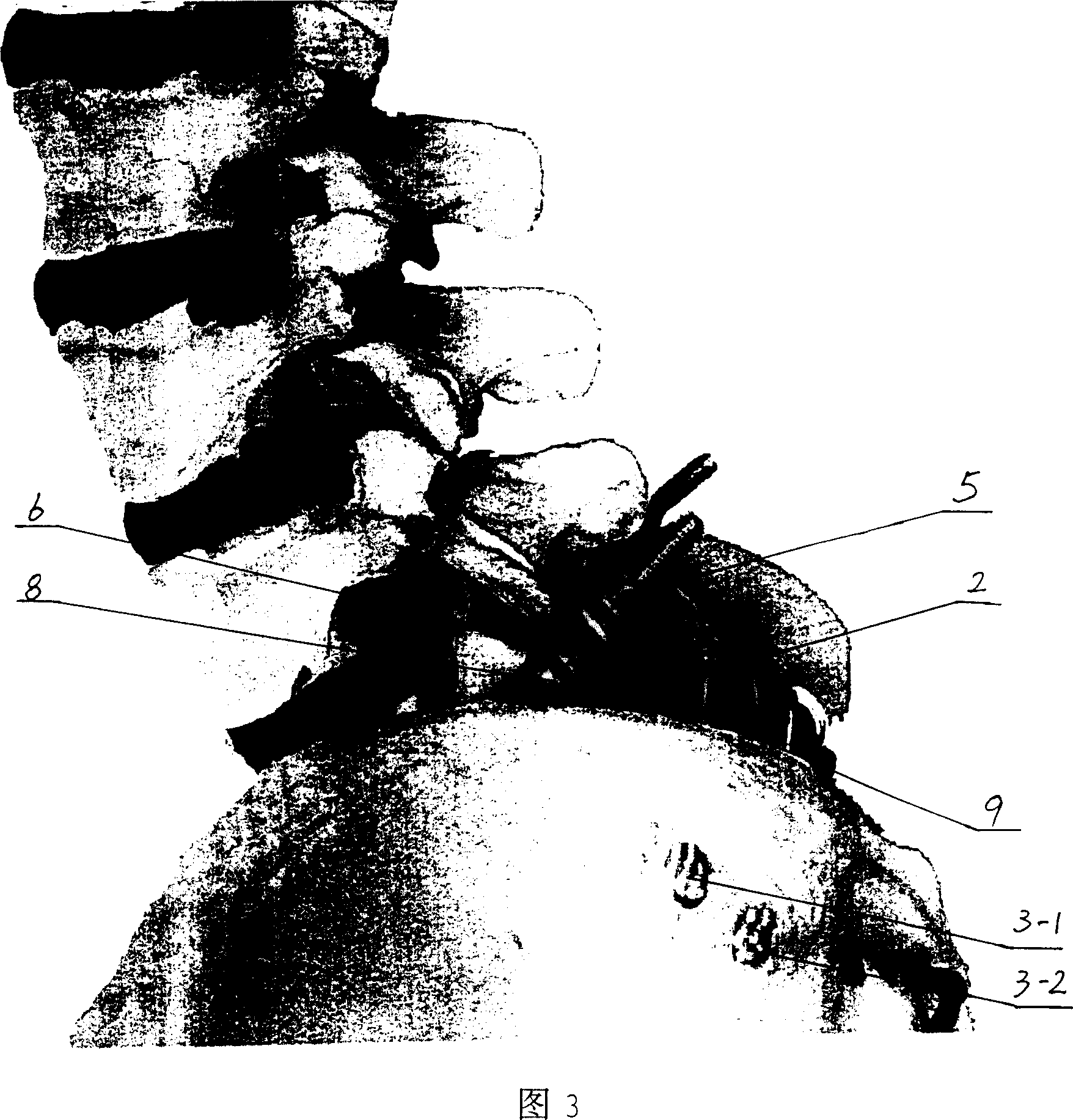 Pelvis and spinal column internal fixing device for treating lumbar vertebrae olisthy olisthe