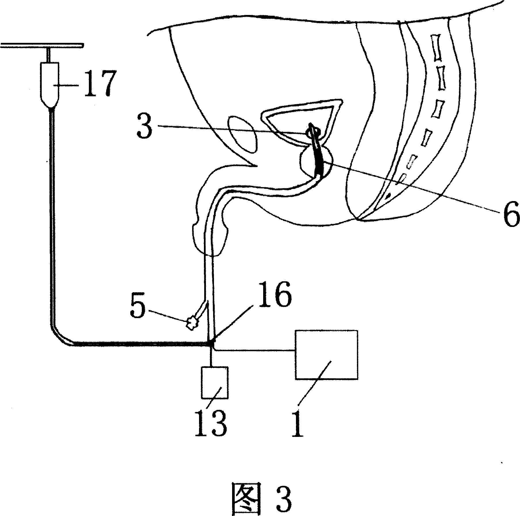 Apparatus for treating prostate diseases, and its making method