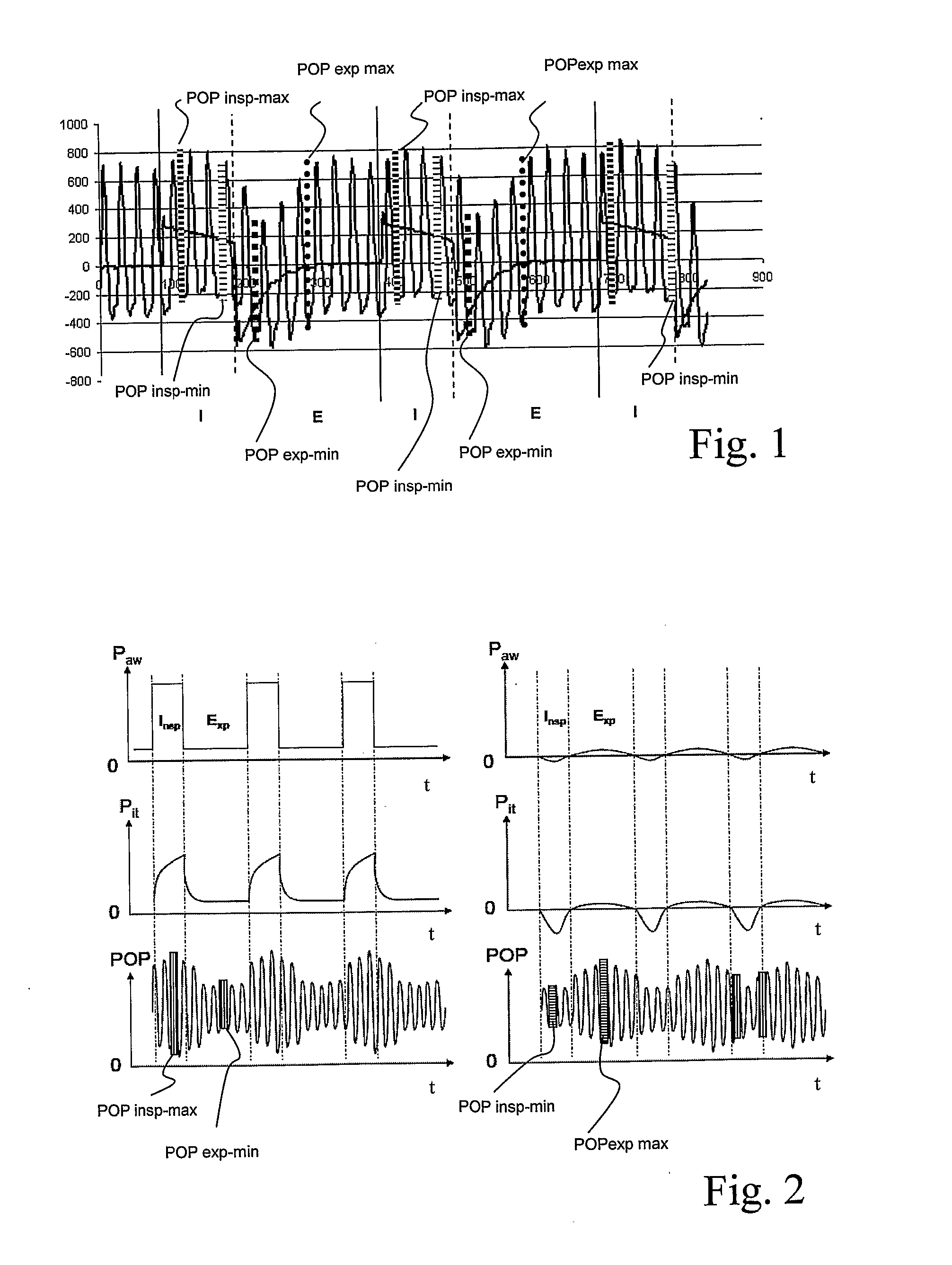 Apparatus for assessing the stress on the circulation of a person during assisted breathing by means of a respirator
