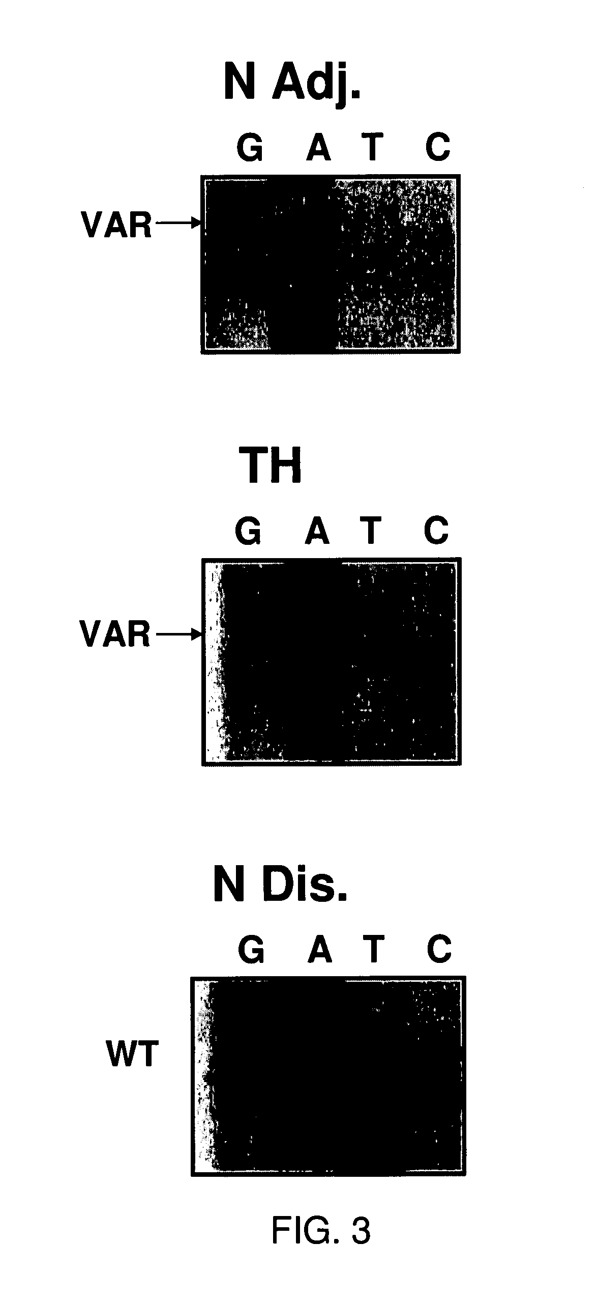 Methods and compositions in breast cancer diagnosis and therapeutics