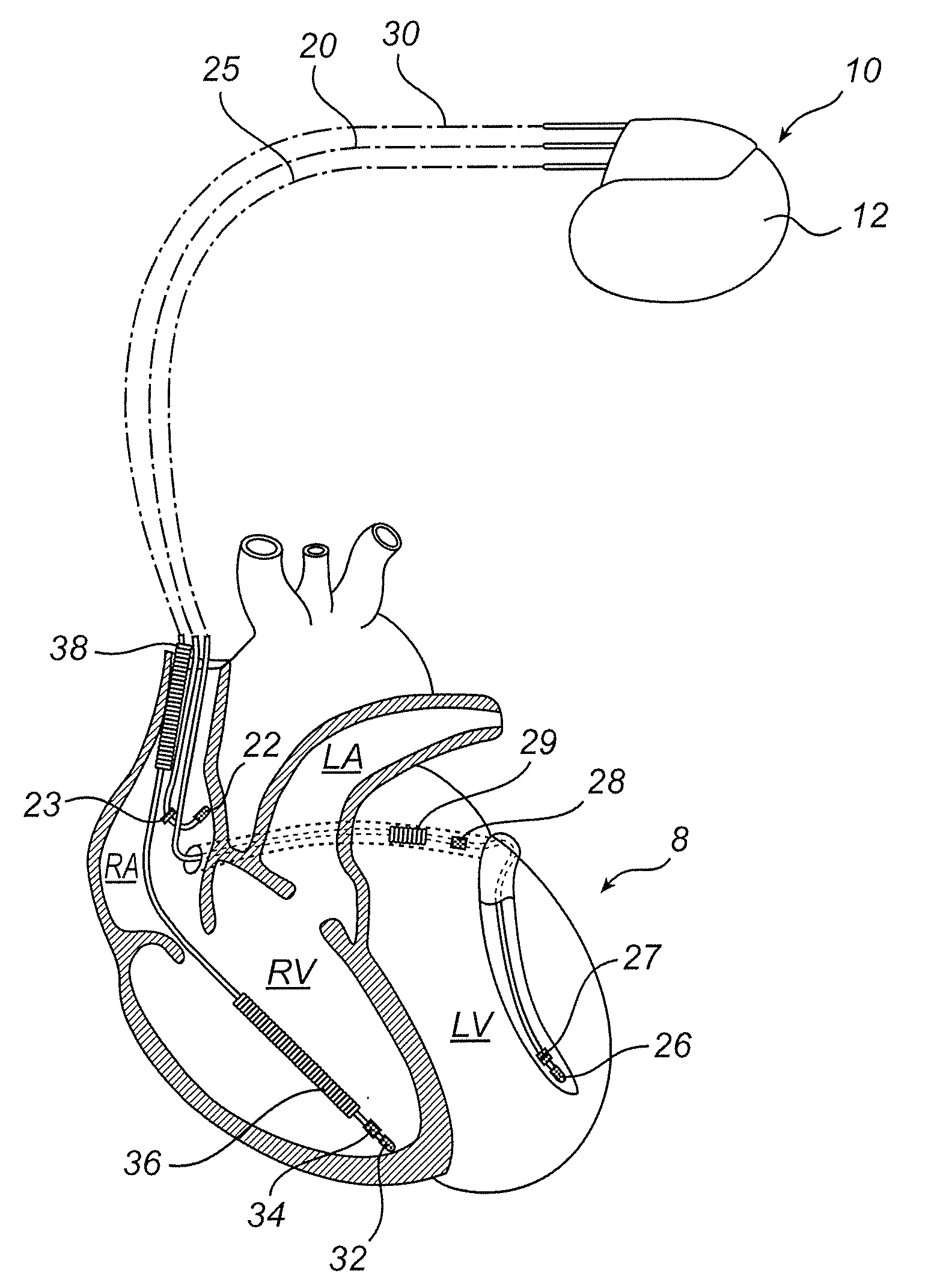 Implantable medical device and method for such a device for predicting hf status of a patient