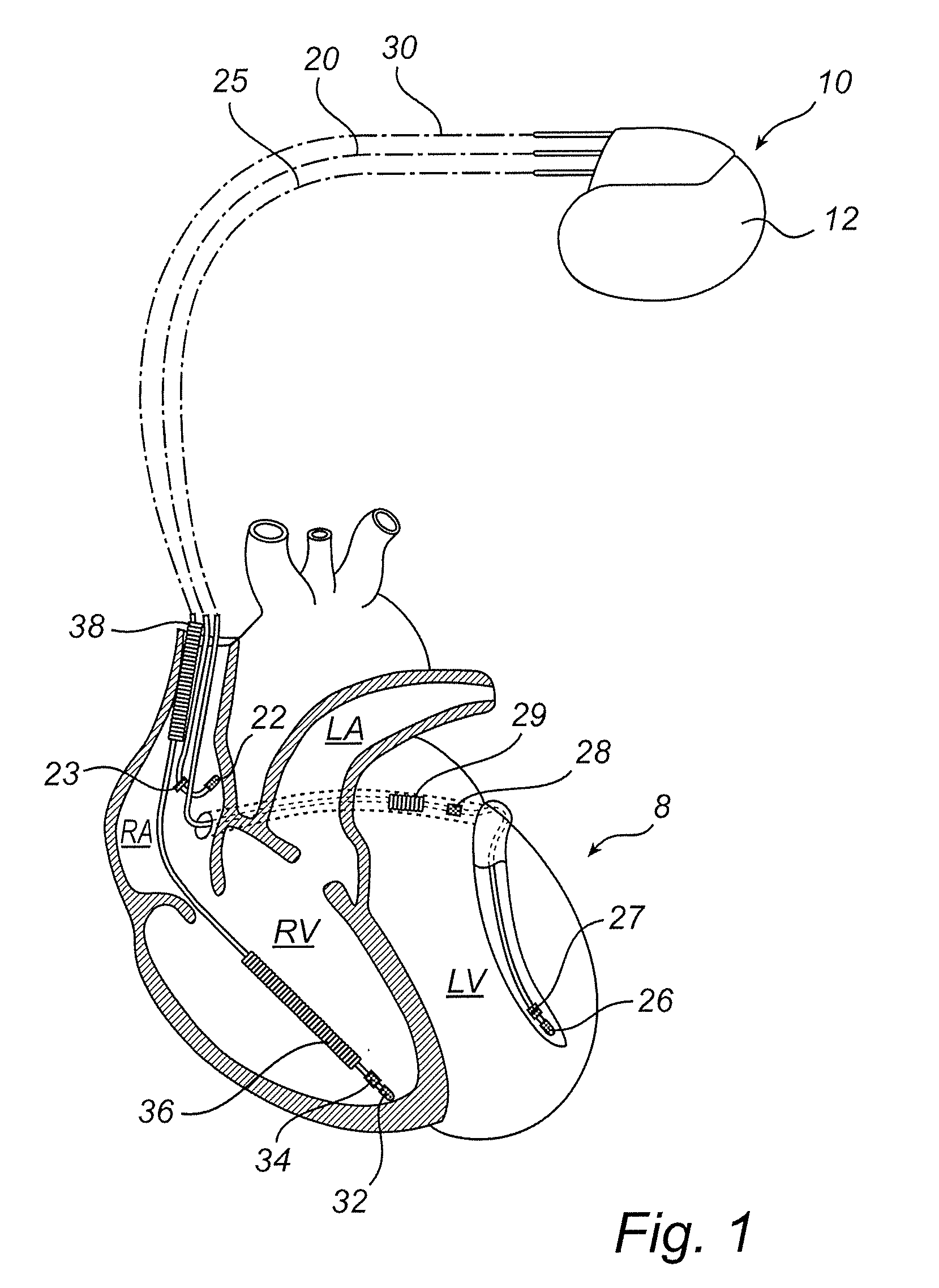 Implantable medical device and method for such a device for predicting hf status of a patient