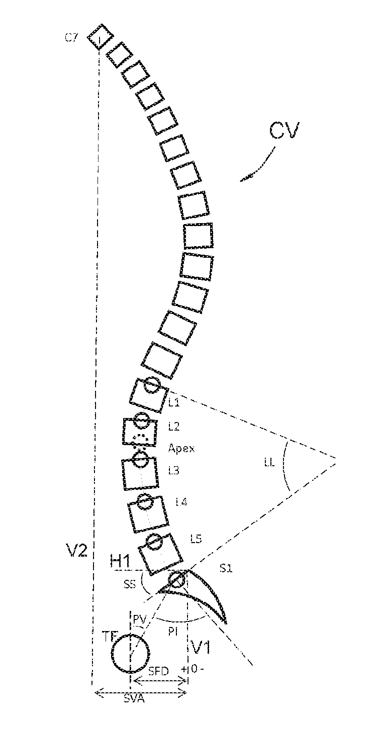 Method making it possible to produce the ideal curvature of a rod of vertebral osteosynthesis material designed to support a patient's vertebral column