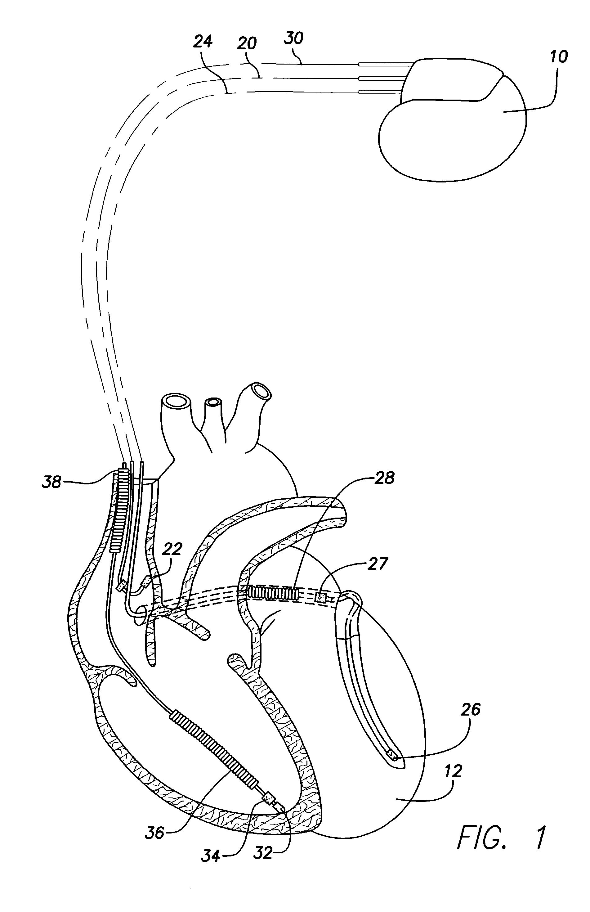 System for the selective activation of functions in an implantable device by a magnetic field
