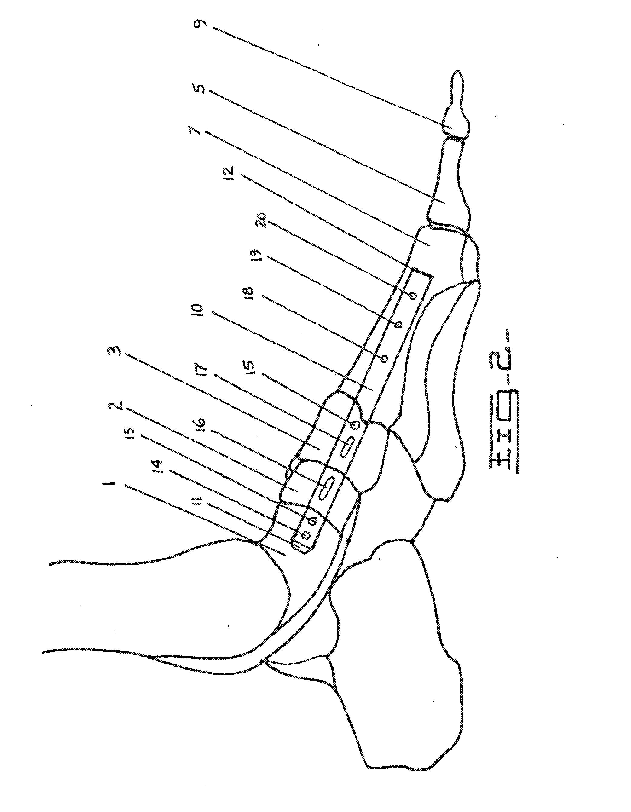 Method and Apparatus for Repairing the Mid-Foot Region Via an Intramedullary Nail