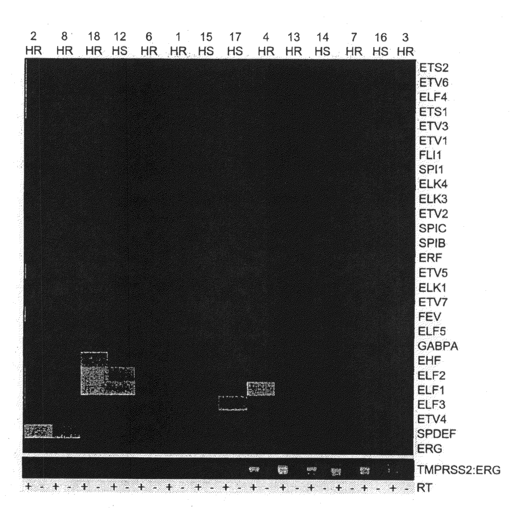 Method for treatment of prostate cancer and screening of patients benefiting from said method