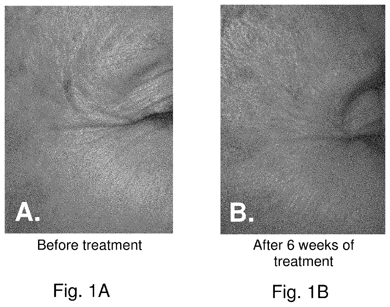 Stem Cell Stimulating Compositions for Treatment of Melasma