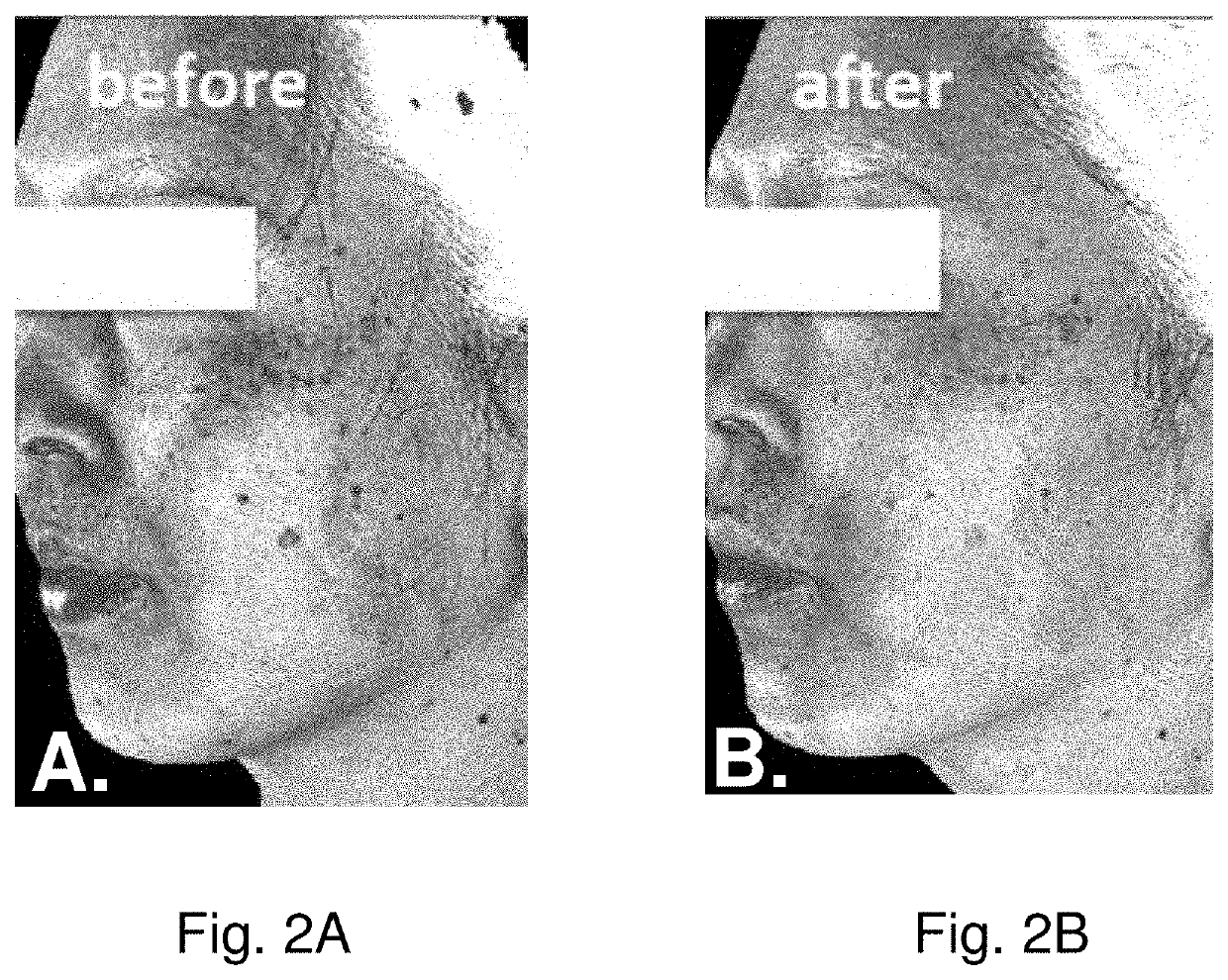 Stem Cell Stimulating Compositions for Treatment of Melasma
