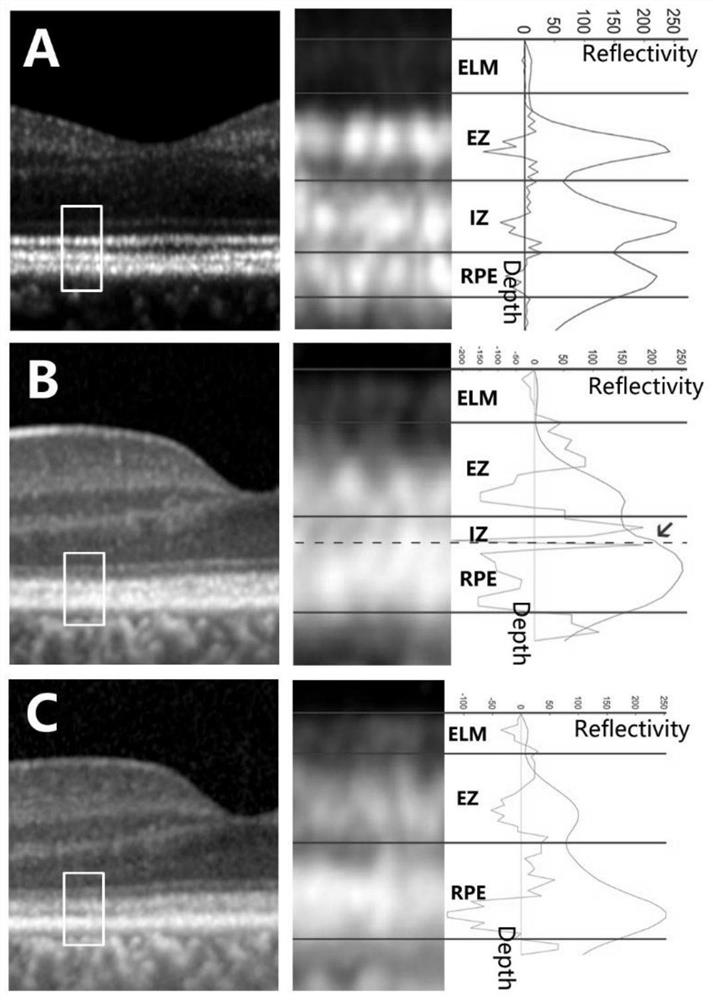 Quantitative detection method based on ophthalmic retina OCT image