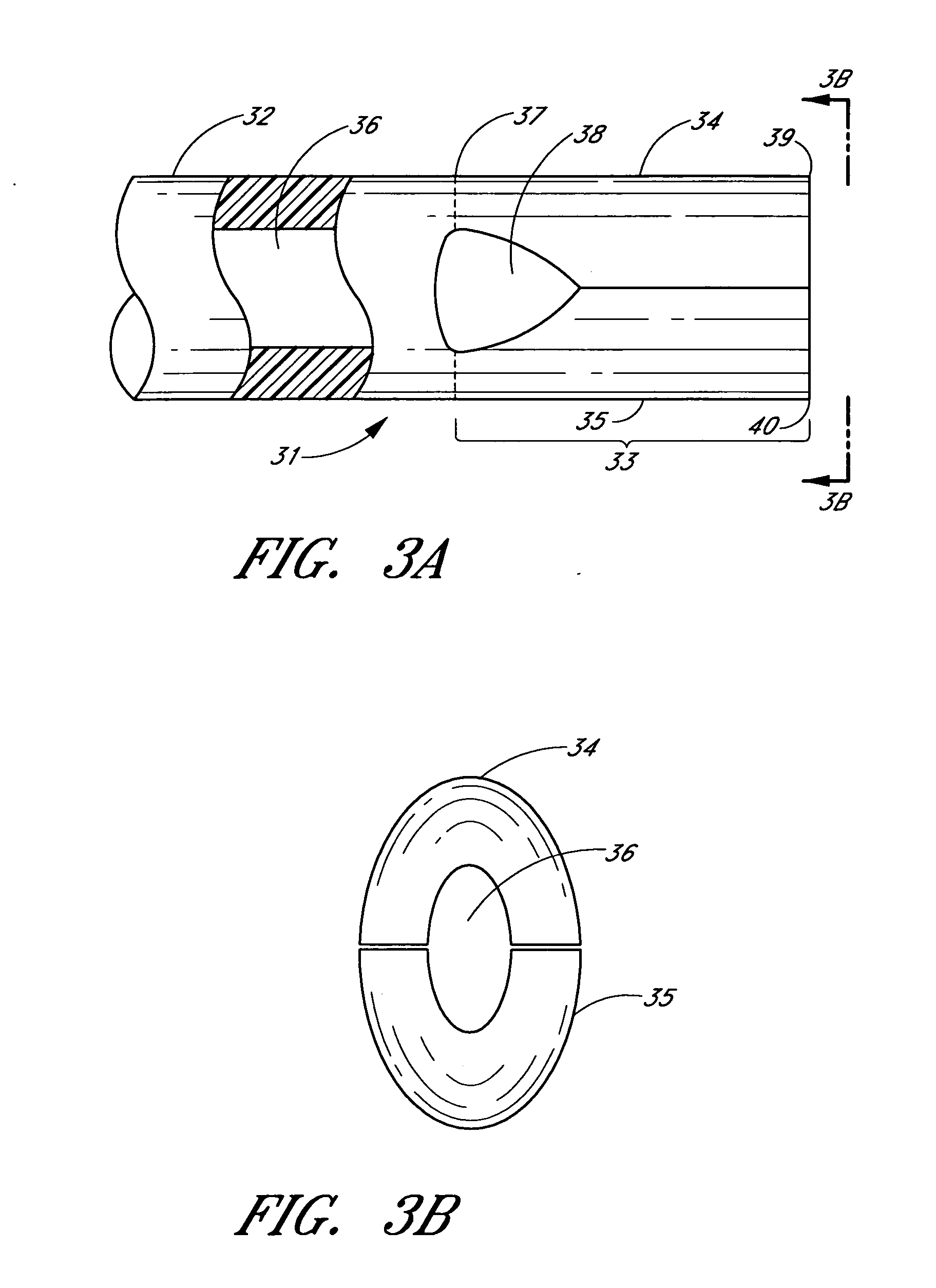 Implant with intraocular pressure sensor for glaucoma treatment