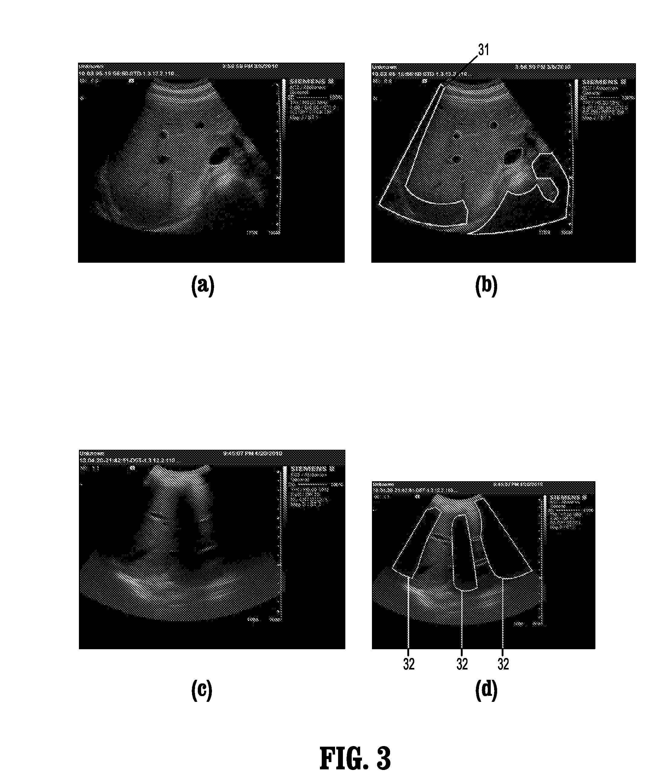 System and method for detection of acoustic shadows and automatic assessment of image usability in 3D ultrasound images