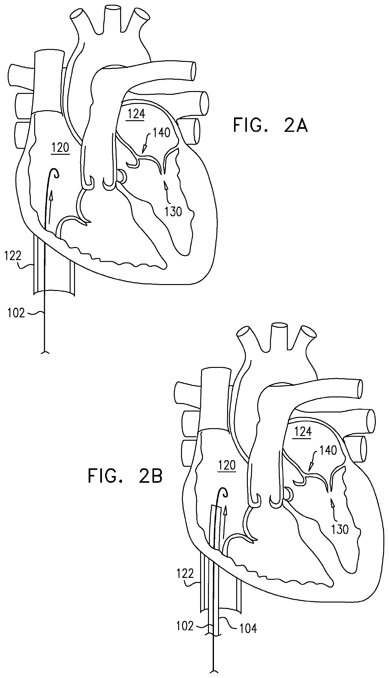 Closed band for percutaneous annuloplasty