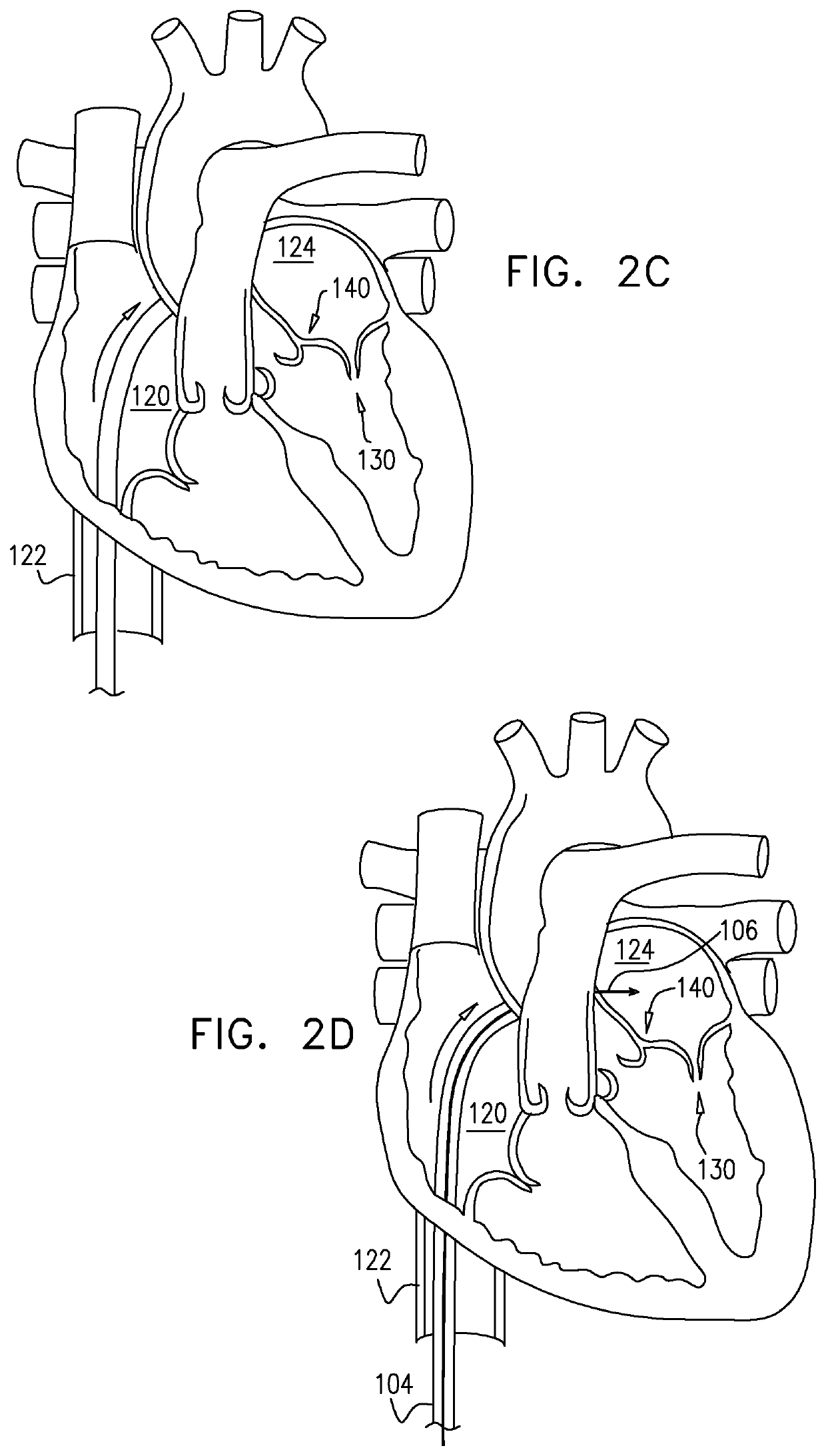 Closed band for percutaneous annuloplasty