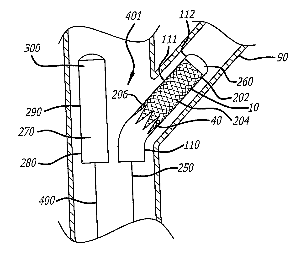 System and method for deploying a proximally-flaring stent