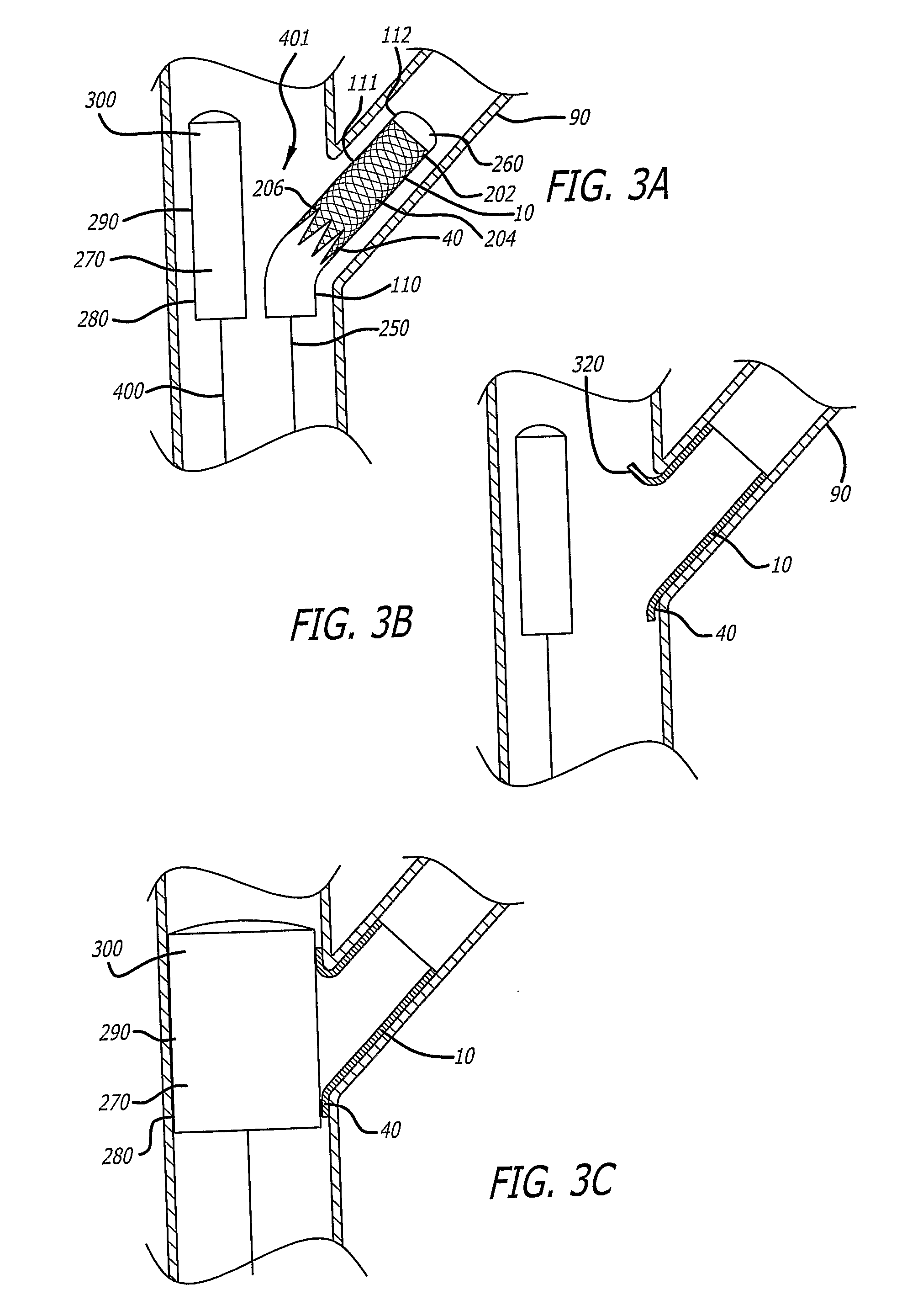 System and method for deploying a proximally-flaring stent