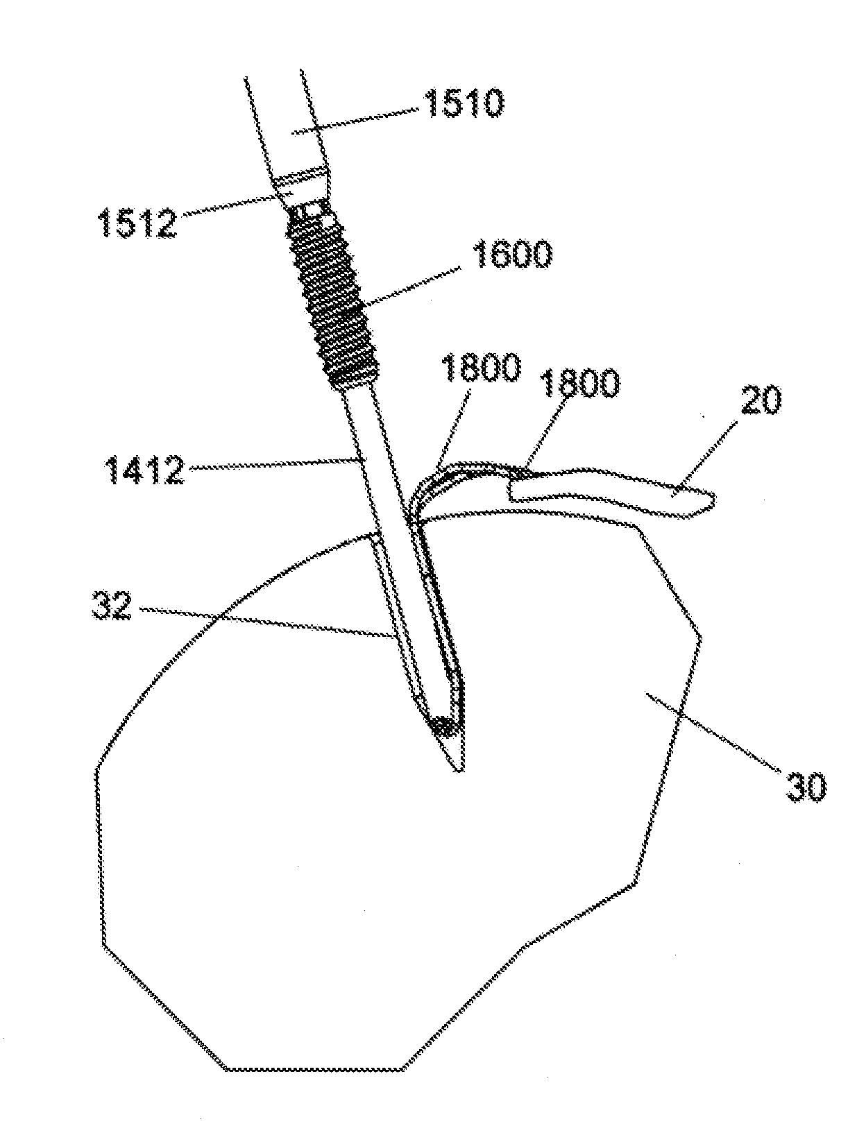 Implant placement systems, devices and methods