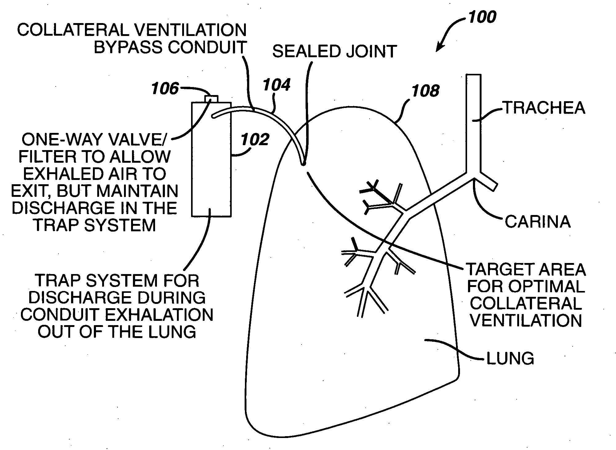 Variable resistance pulmonary ventilation bypass valve