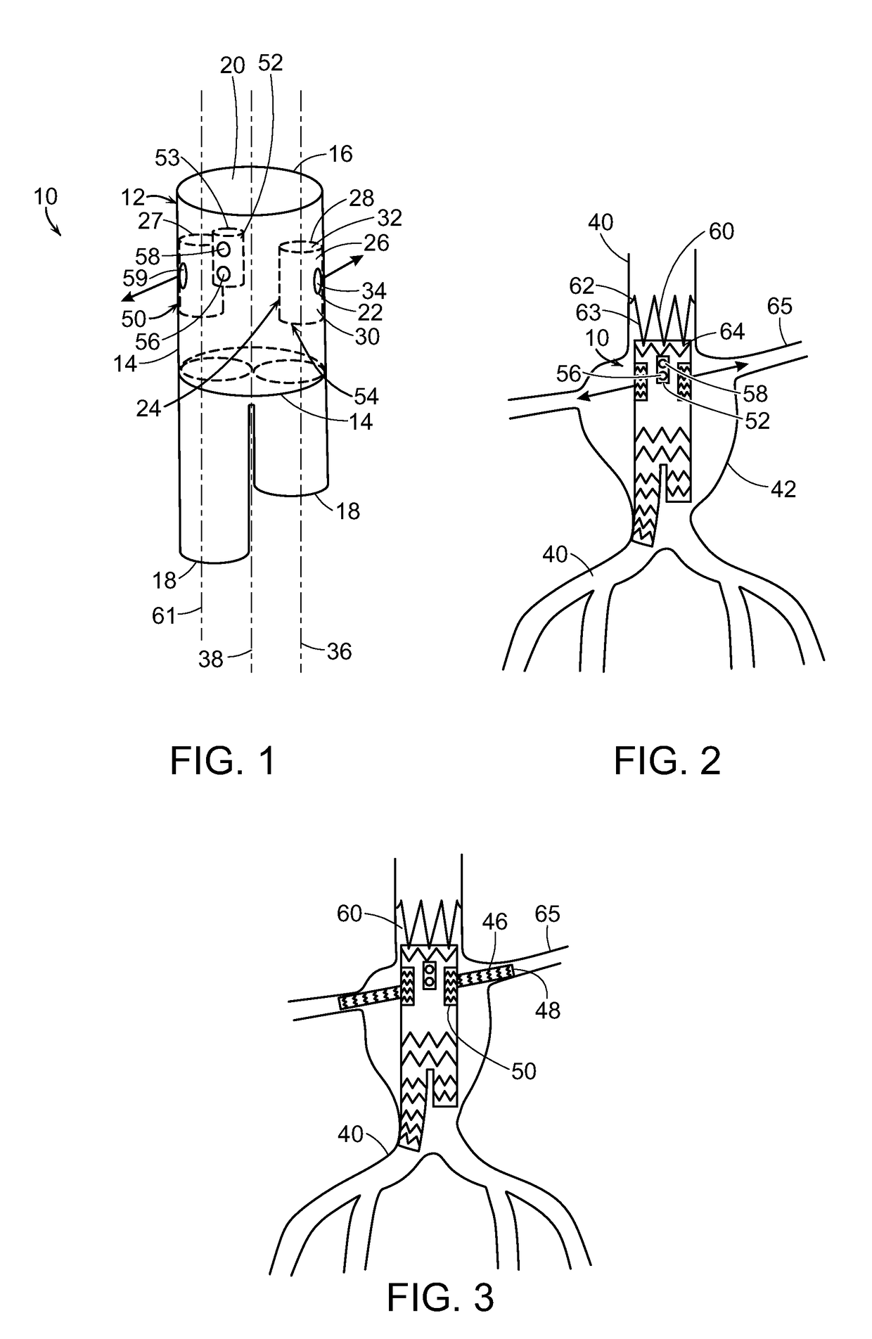 Stent graft with internal tunnels and fenestrations and methods of use