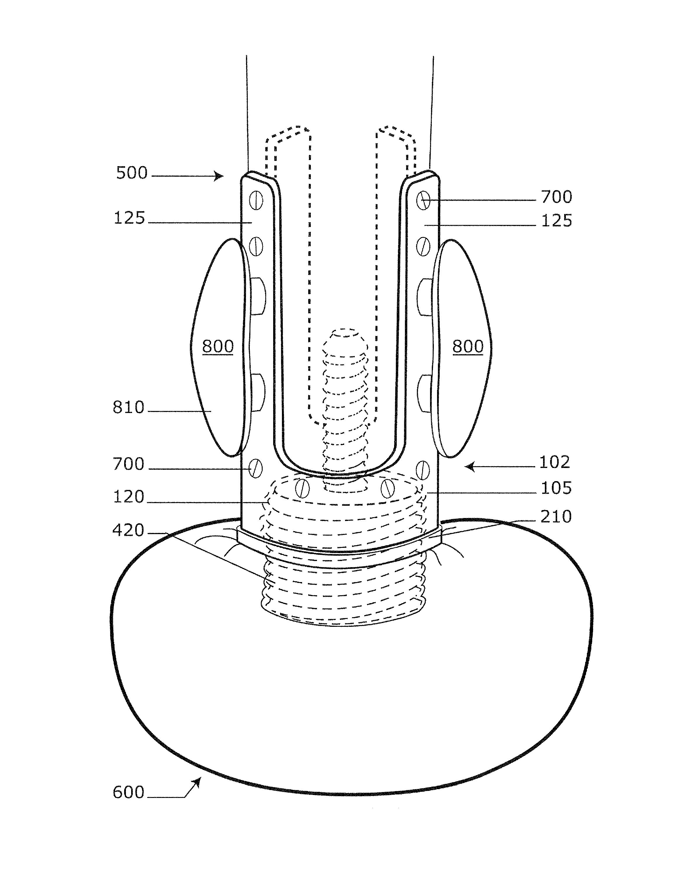 Implantable prosthetic device for distribution of weight on amputated limb and method of use with an external prosthetic device