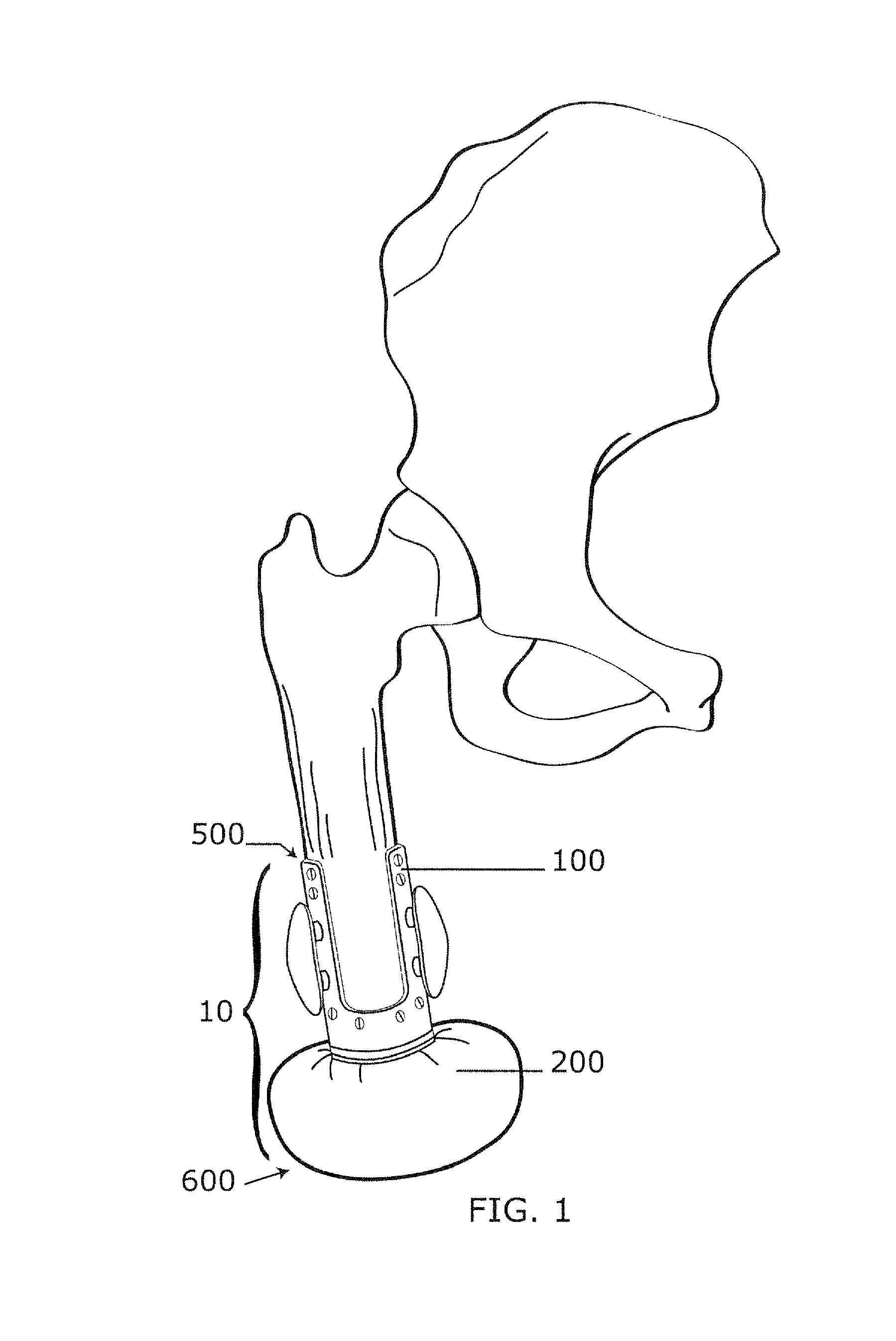 Implantable prosthetic device for distribution of weight on amputated limb and method of use with an external prosthetic device