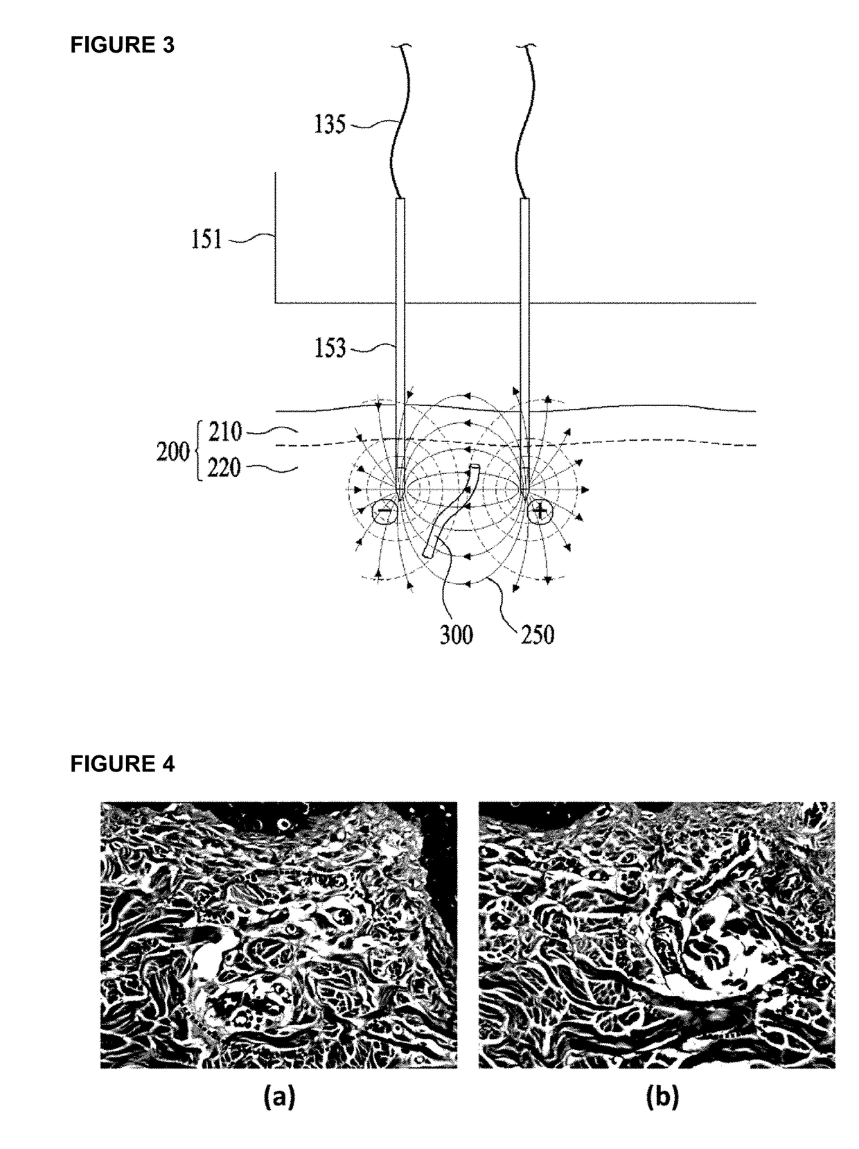 Apparatus for treating blood vessels in skin
