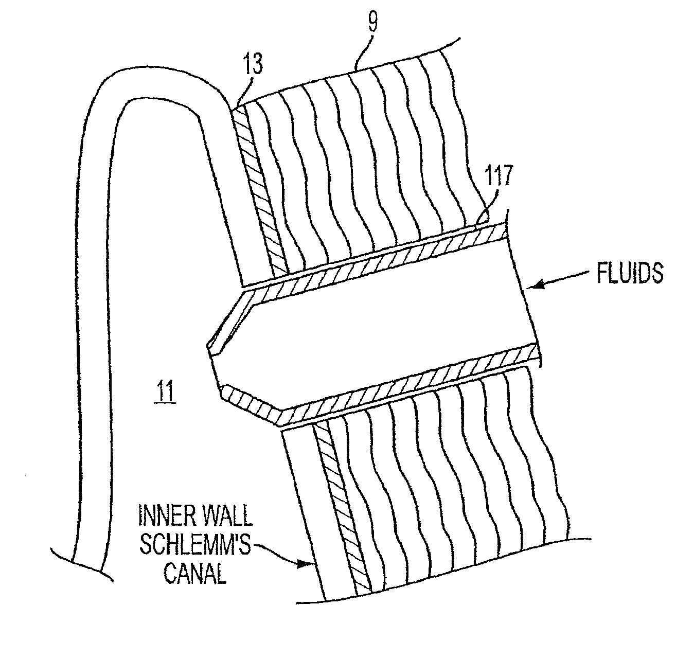 Delivery system and method of use for the eye
