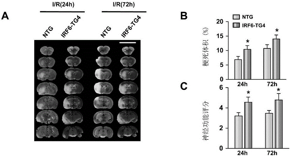 Interferon regulatory factor (IRF) 6 and application of IRF 6 inhibitor to brain stroke disease