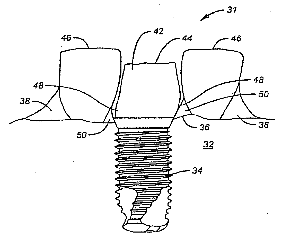 System for Immediately Placing a Non-Occlusive Dental Implant Prosthesis