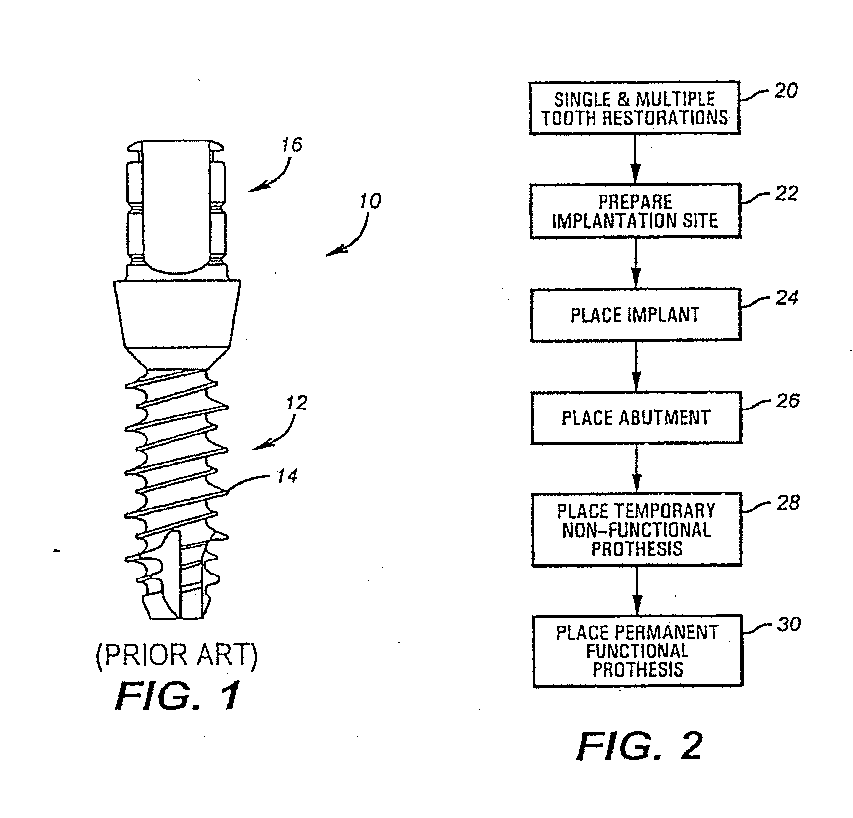 System for Immediately Placing a Non-Occlusive Dental Implant Prosthesis