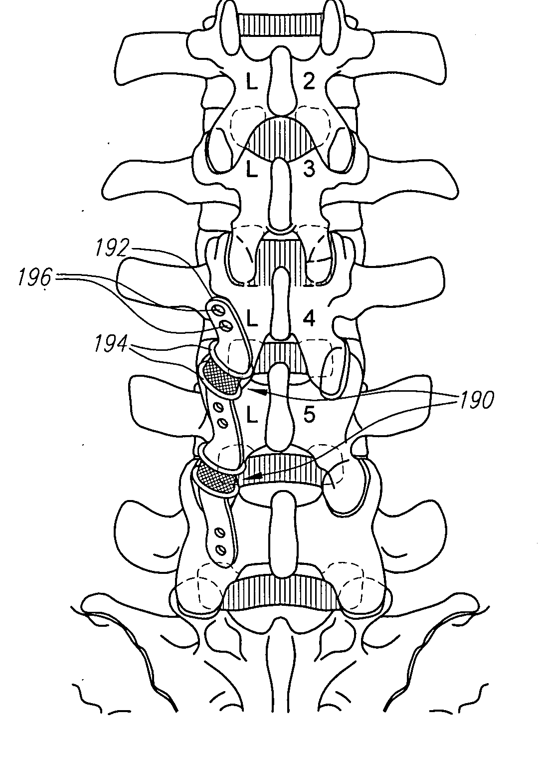 Spinal stabilization systems and methods