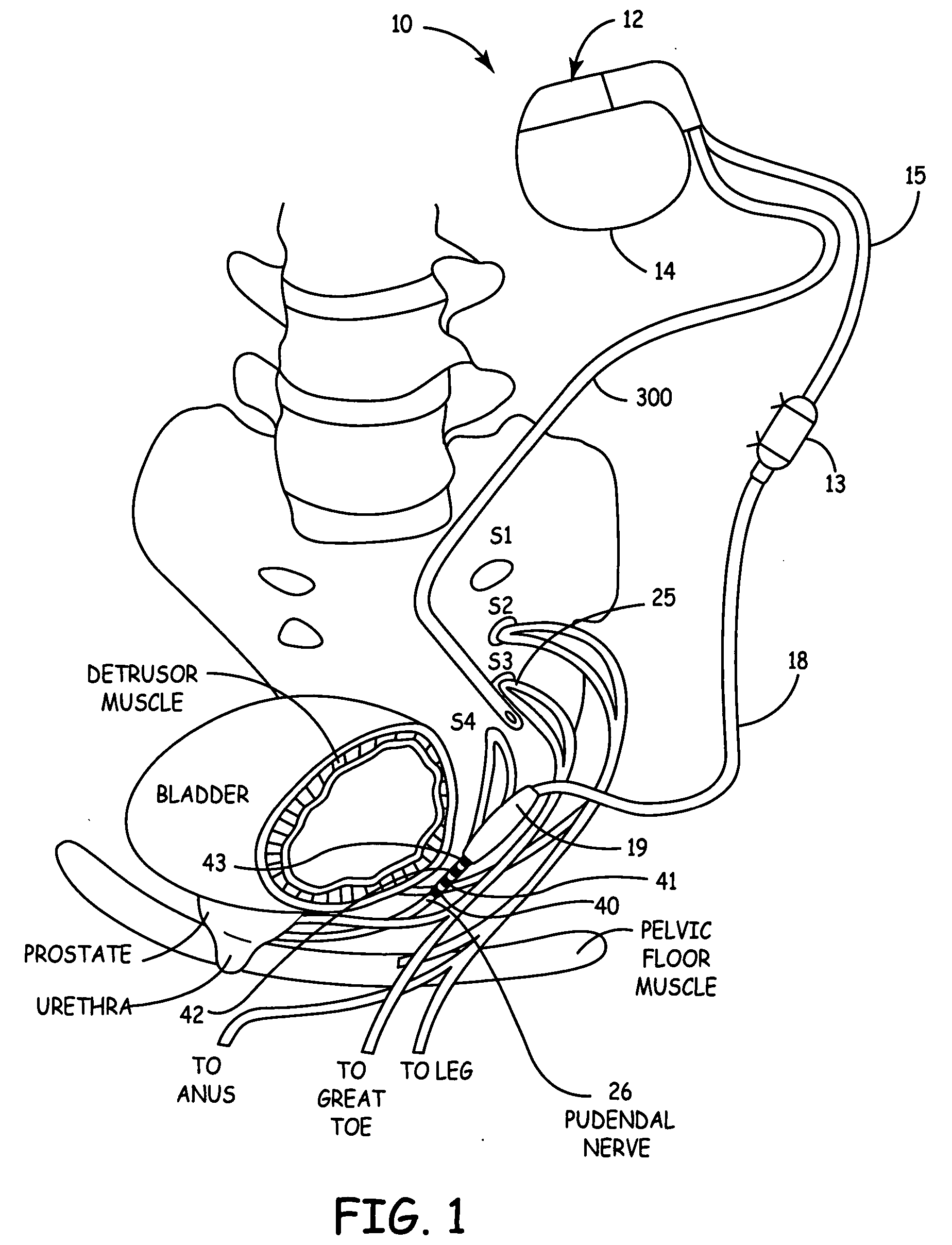 Method, system and device for treating disorders of the pelvic floor by drug delivery to the pudendal and sacral nerves