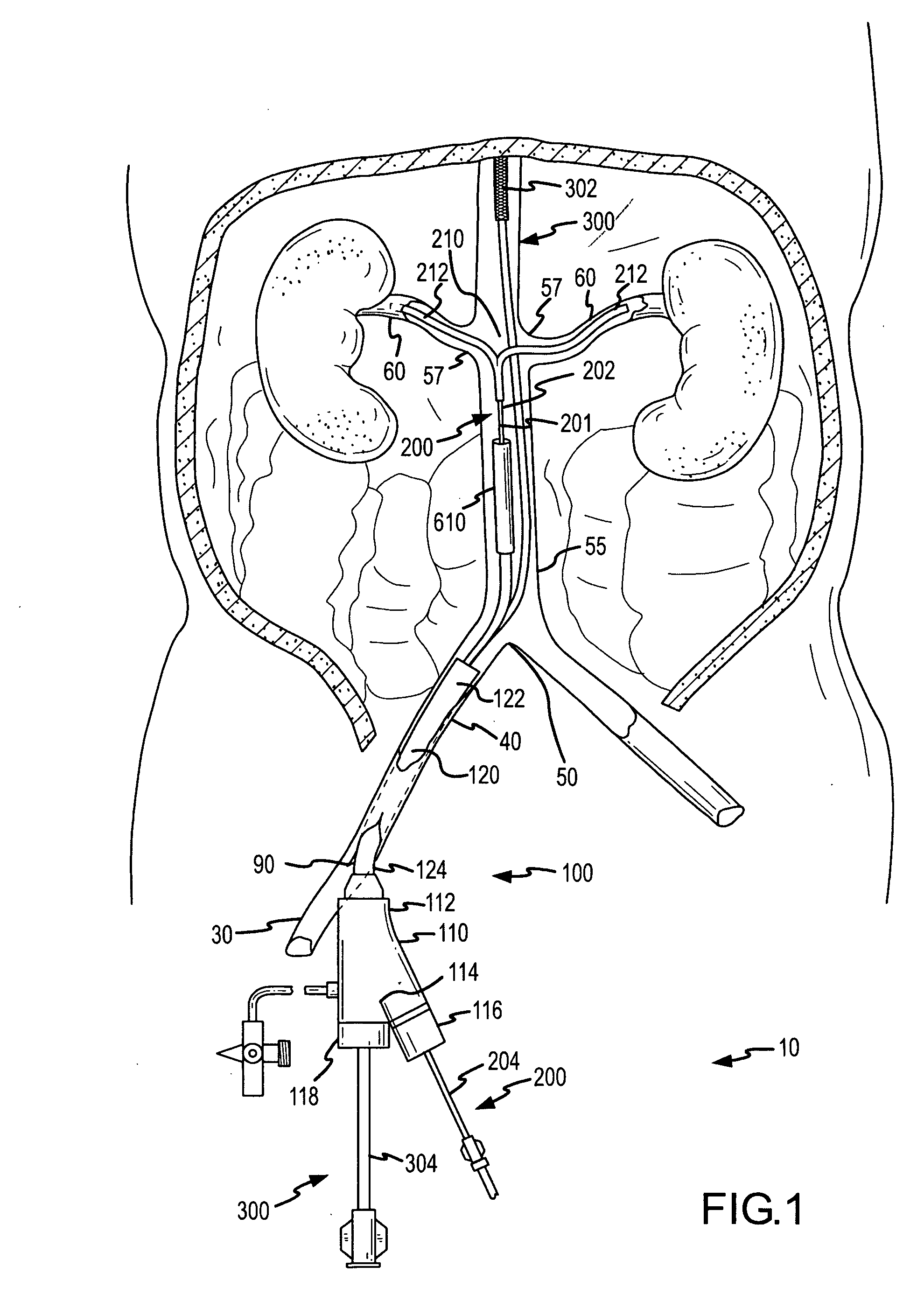 Renal infusion systems and methods