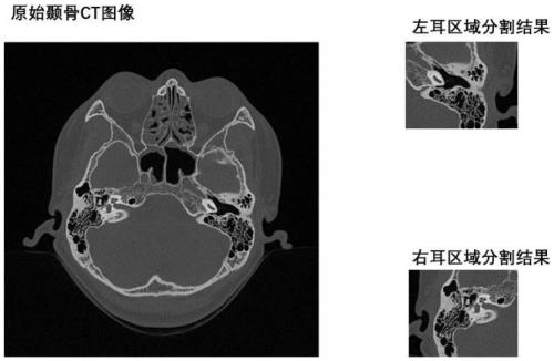 Left and right ear region segmentation method based on temporal bone CT horizontal scanning image