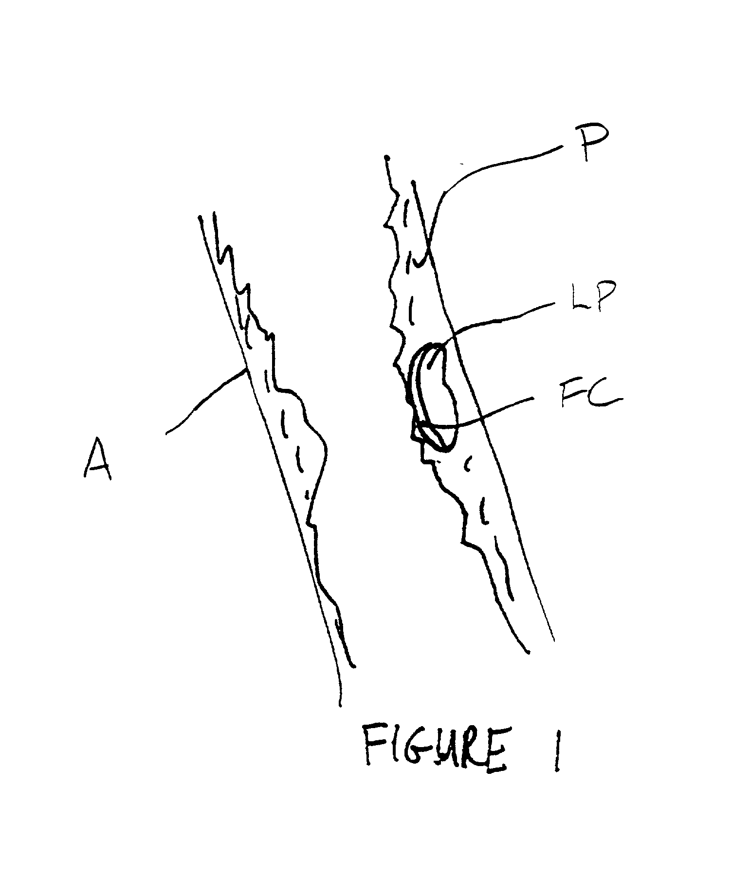 Methods, systems, and kits for plaque stabilization