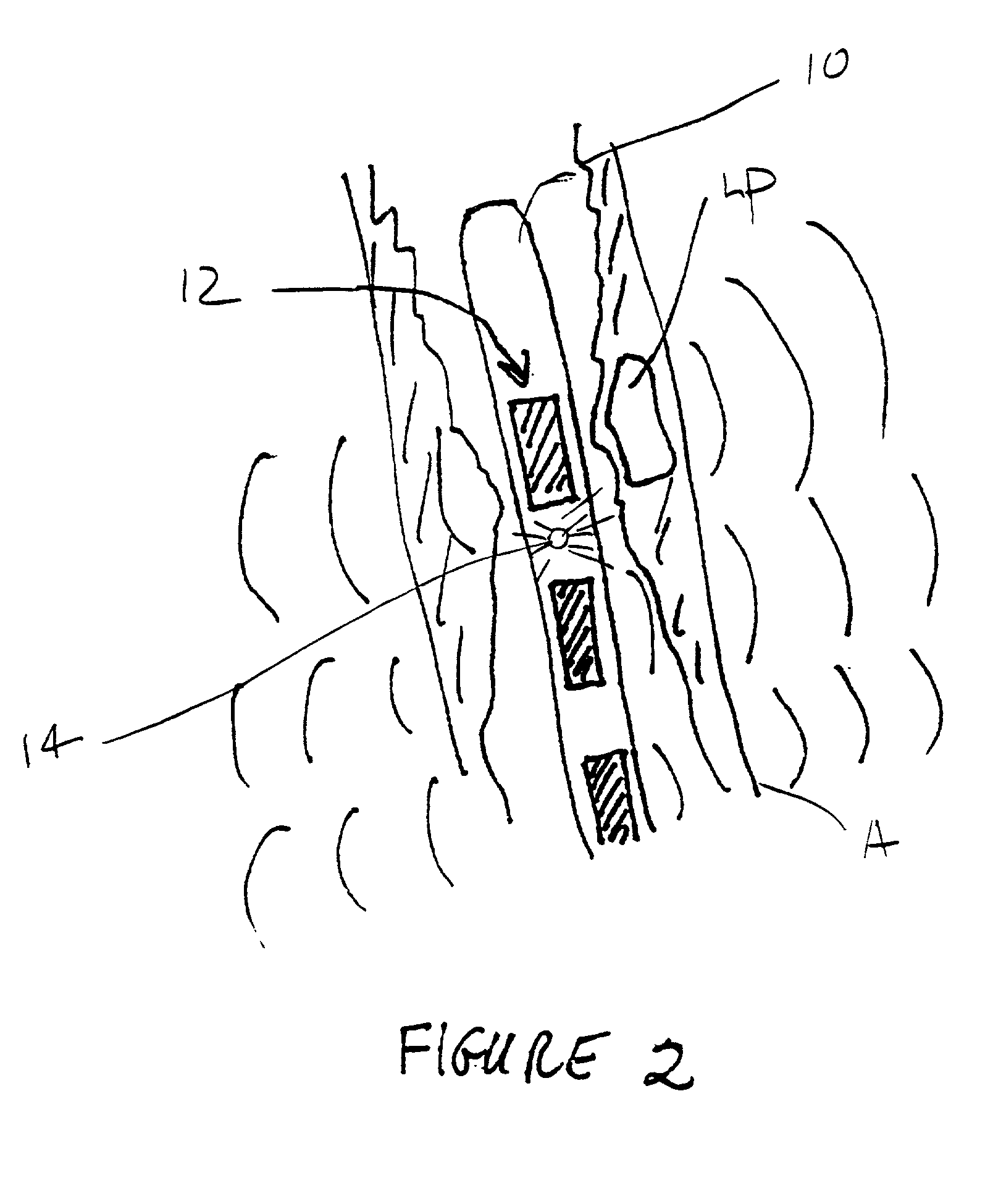 Methods, systems, and kits for plaque stabilization