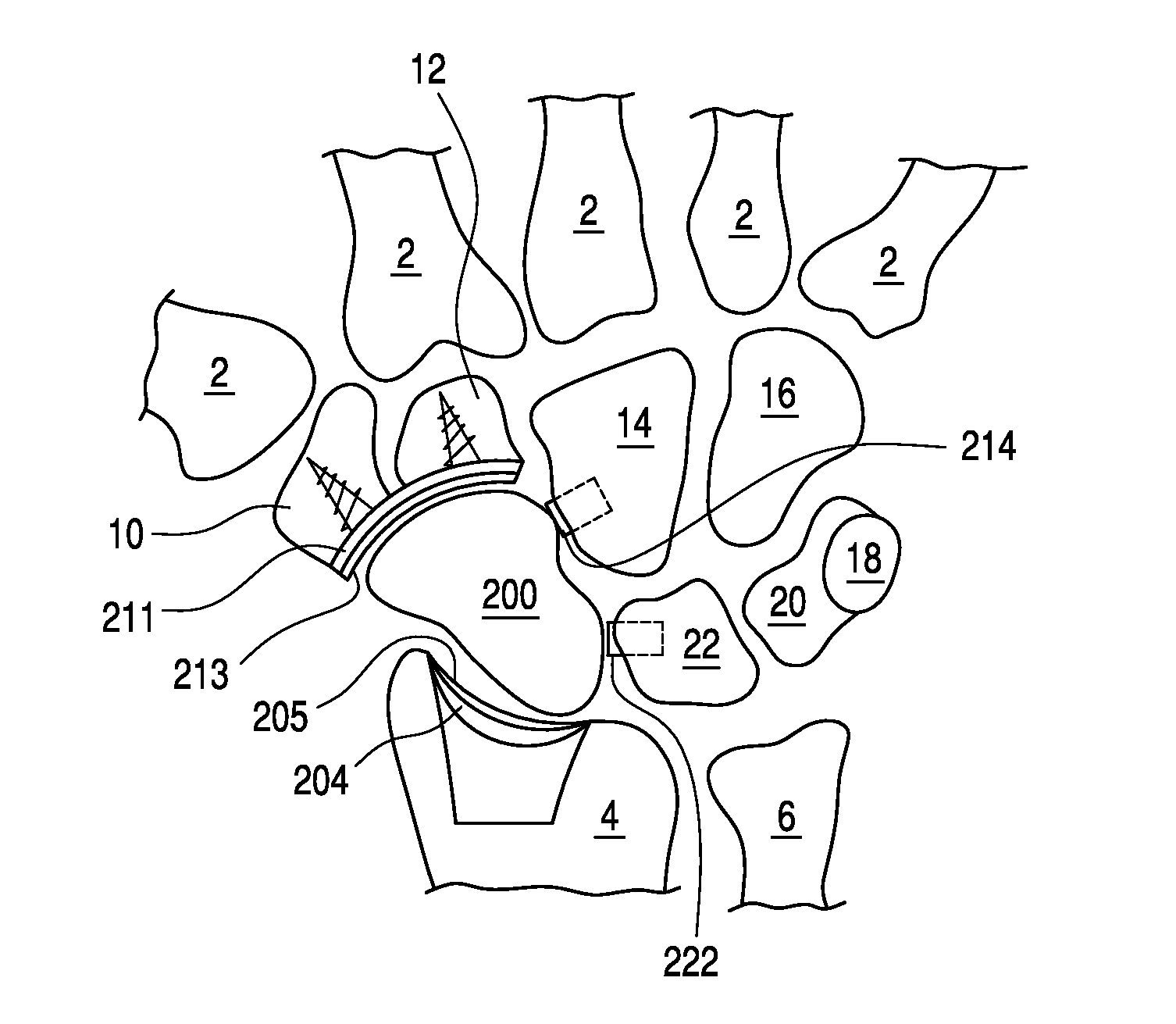 Bone prosthesis for maintaining joint operation in complex joints