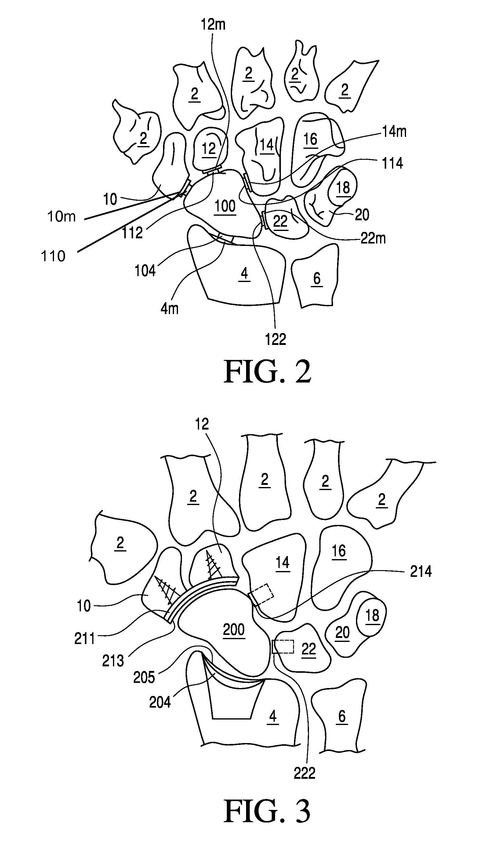 Bone prosthesis for maintaining joint operation in complex joints