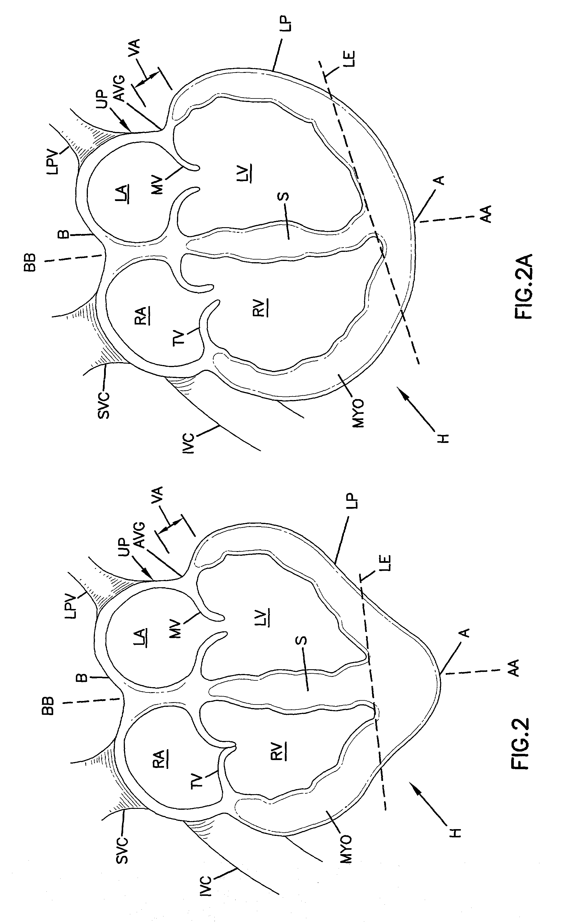 Cardiac support devices and methods of producing same