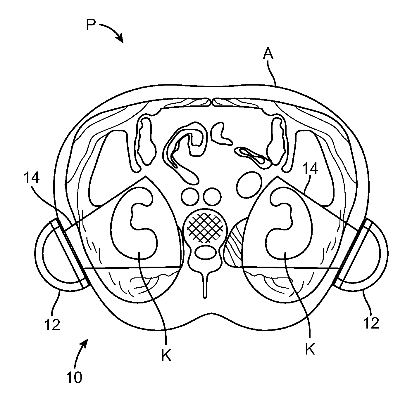 Renal injury inhibiting devices, systems, and methods employing low-frequency ultrasound or other cyclical pressure energies