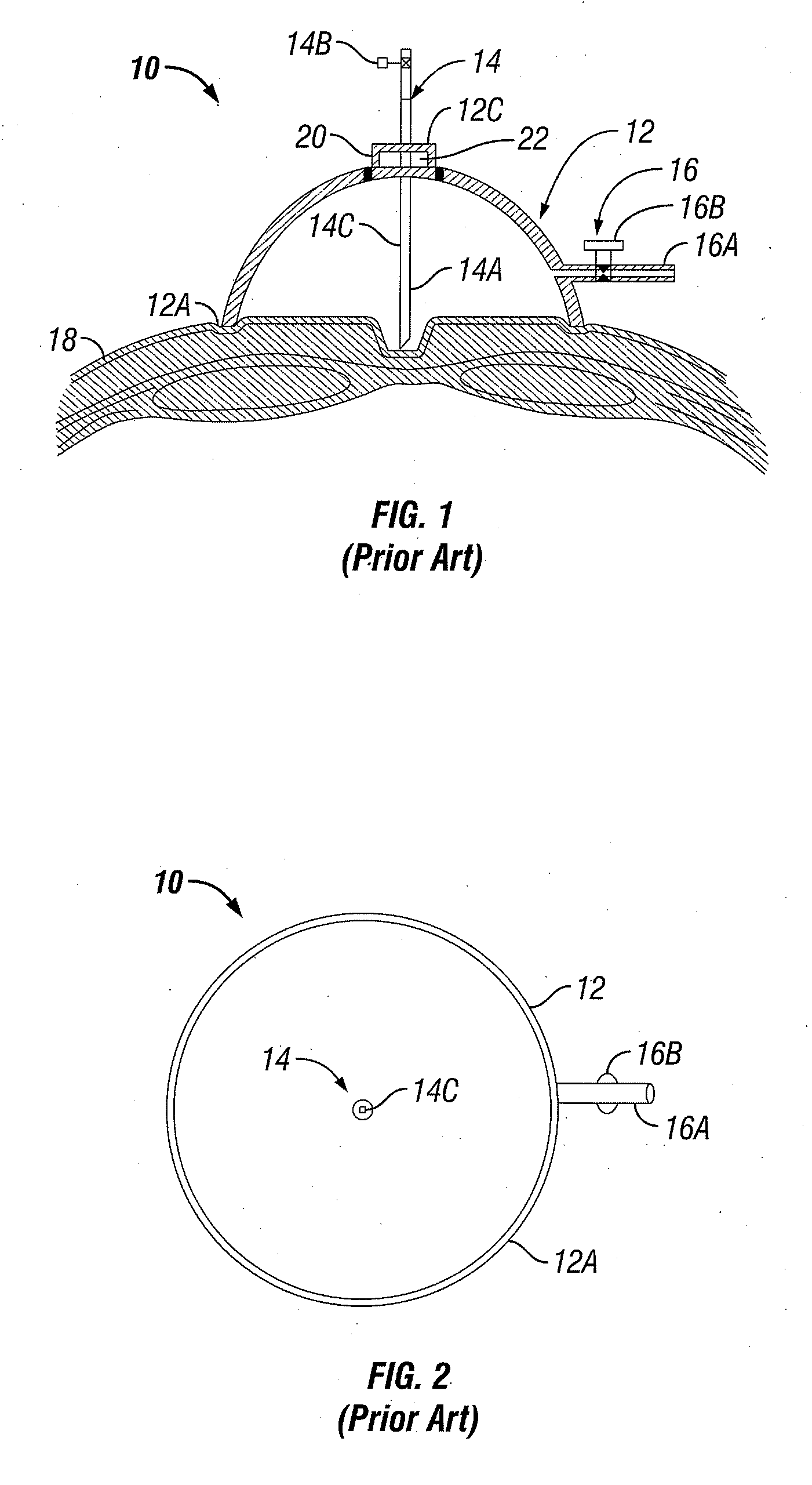 Method and Apparatus for Assisting in the Introduction of Surgical Implements into a Body
