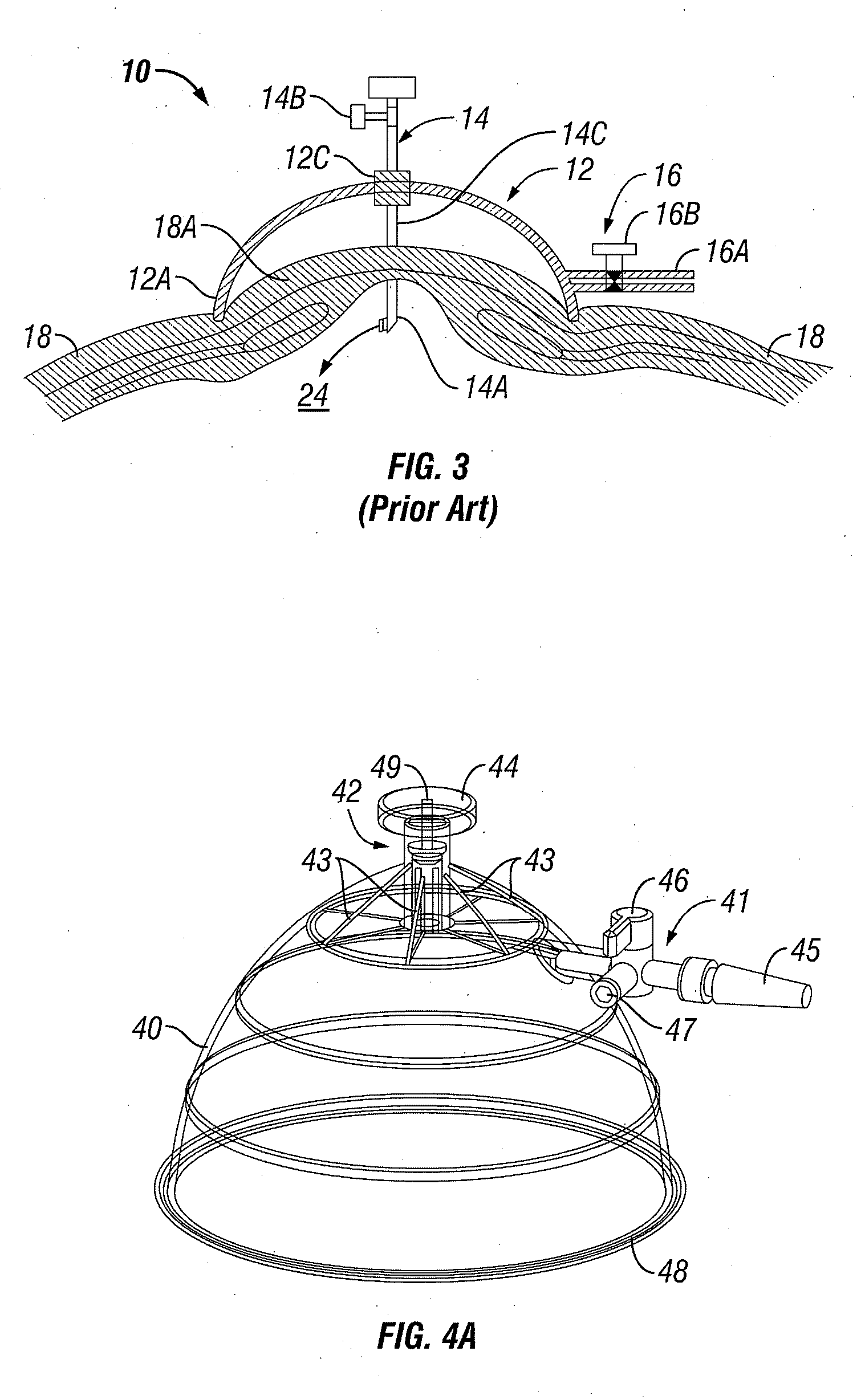 Method and Apparatus for Assisting in the Introduction of Surgical Implements into a Body