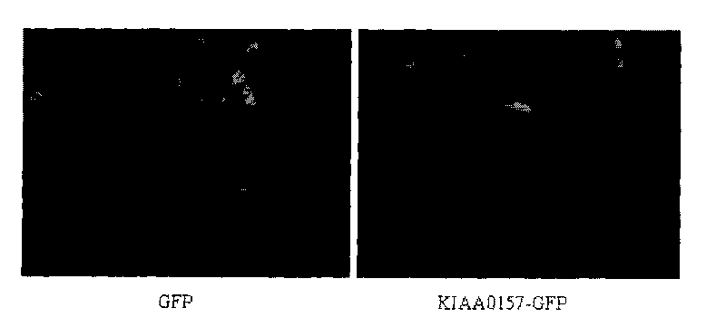 Novel human tumor inhibiting gene KIAA0157 and application thereof