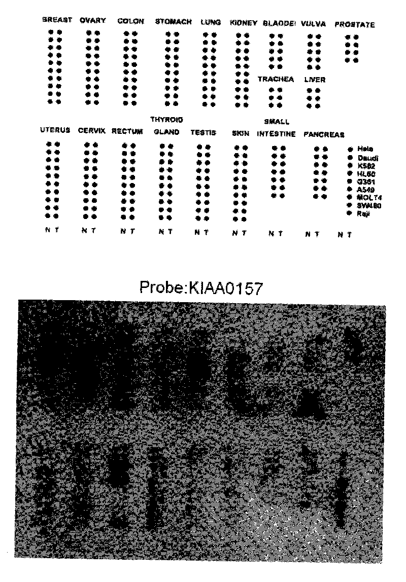 Novel human tumor inhibiting gene KIAA0157 and application thereof