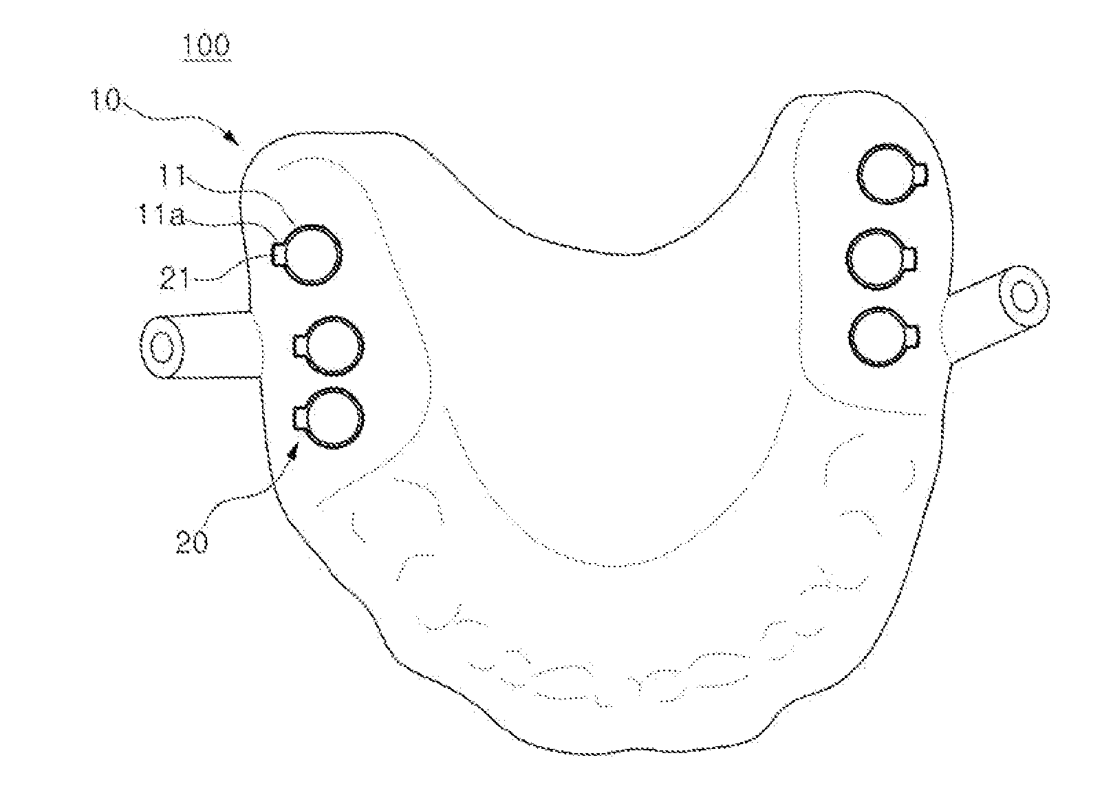 Method of manufacturing guide stent of dental implant