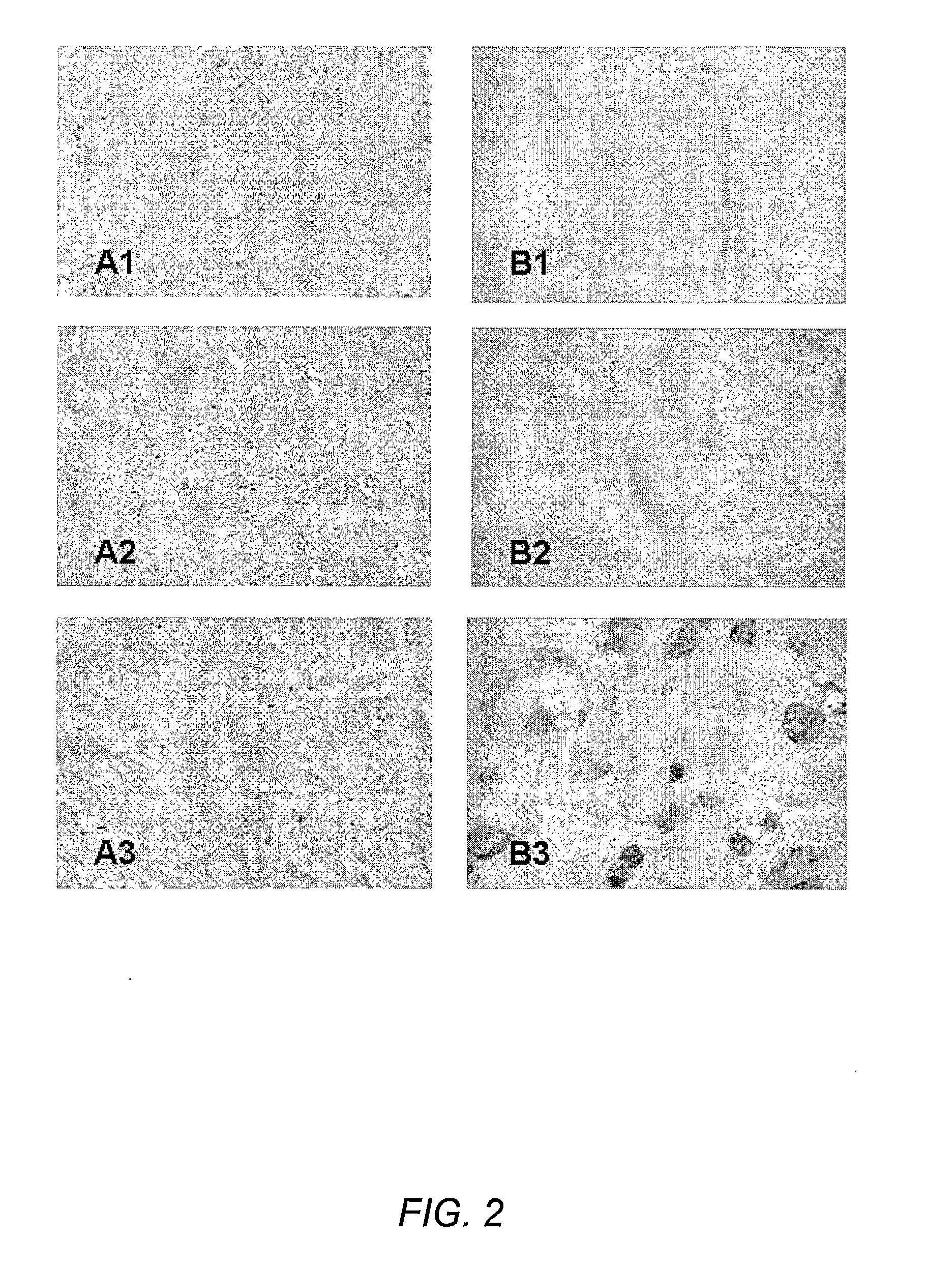 Anti-measles cancer immunotherapy