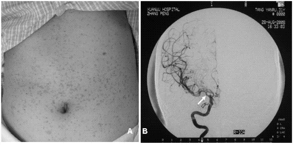 I type neurofibroma NF1 gene mutation nucleotide sequence related to cerebrovascular stenosis and application thereof