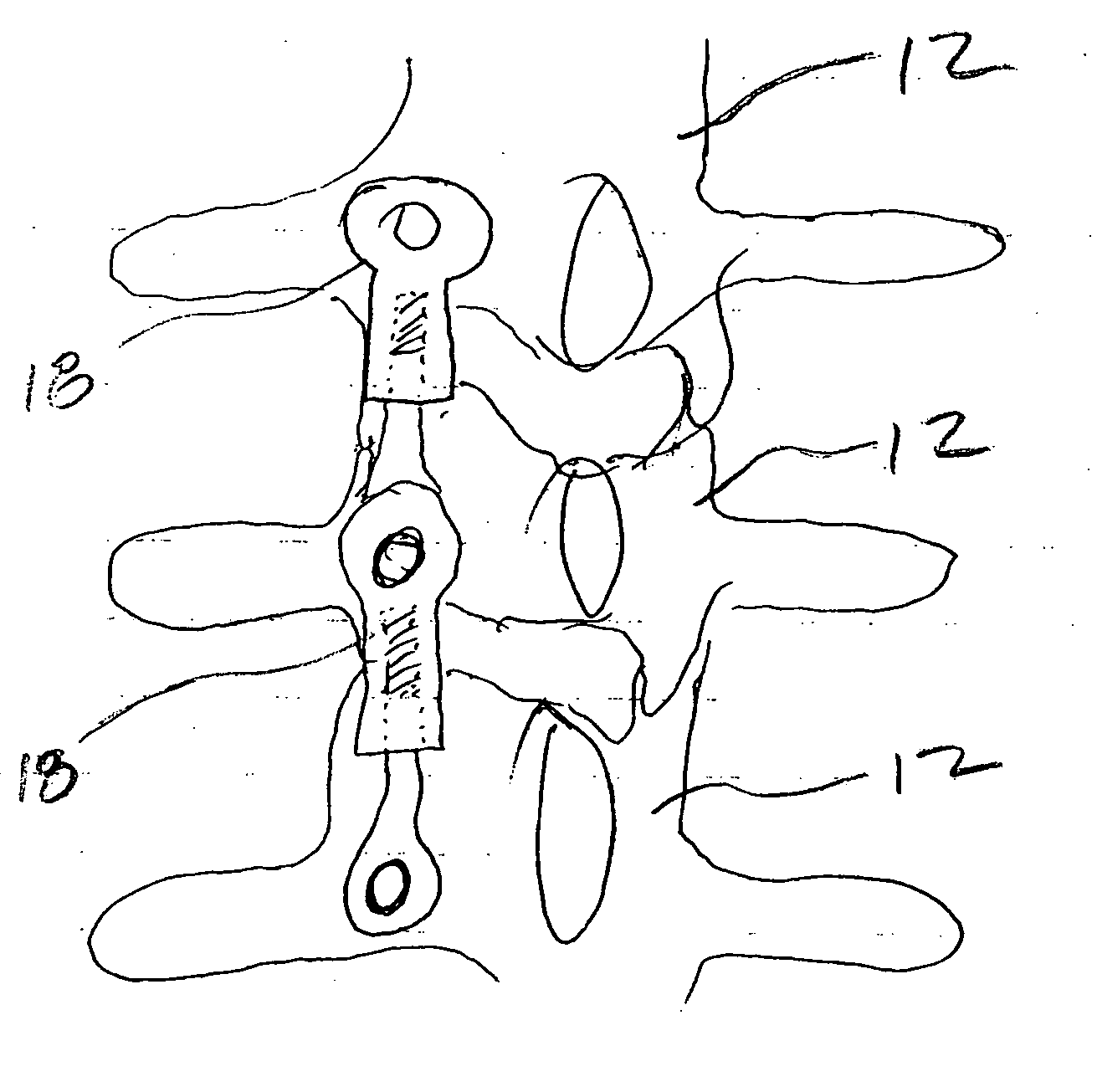Apparatus and method for concave scoliosis expansion