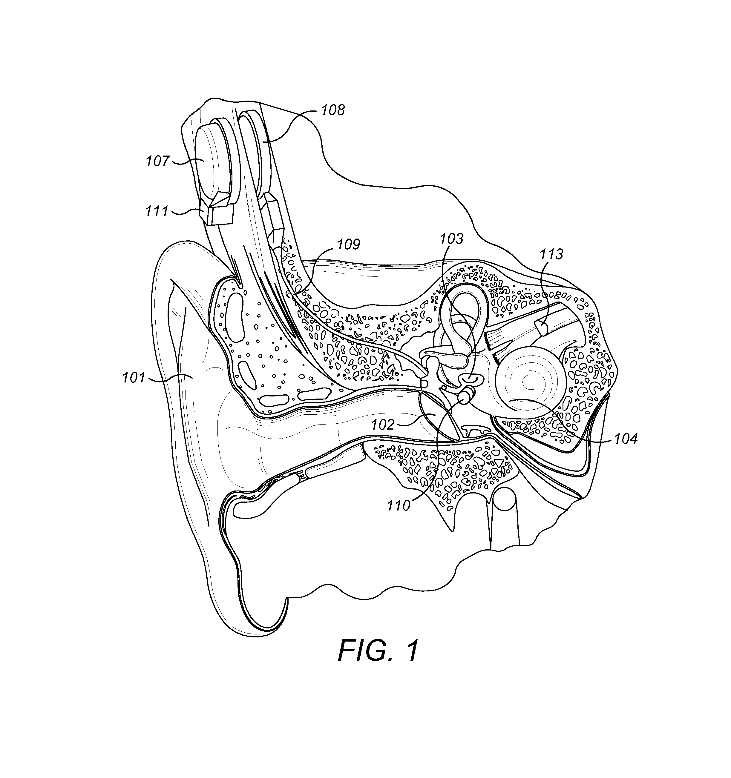 Clover Shape Attachment for Implantable Floating Mass Transducer